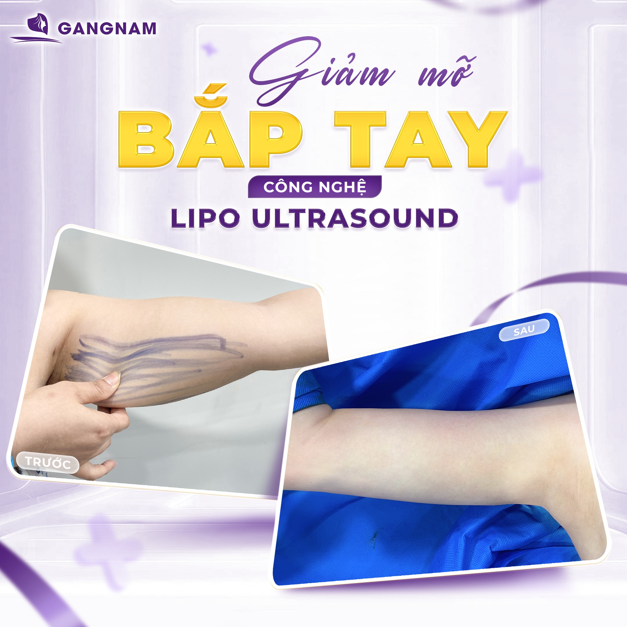 Hút mỡ bắp tay – Giải pháp lấy lại đôi tay thon gọn, tự tin 4 Hút mỡ bắp tay là gì và tại sao nên chọn phương pháp này?