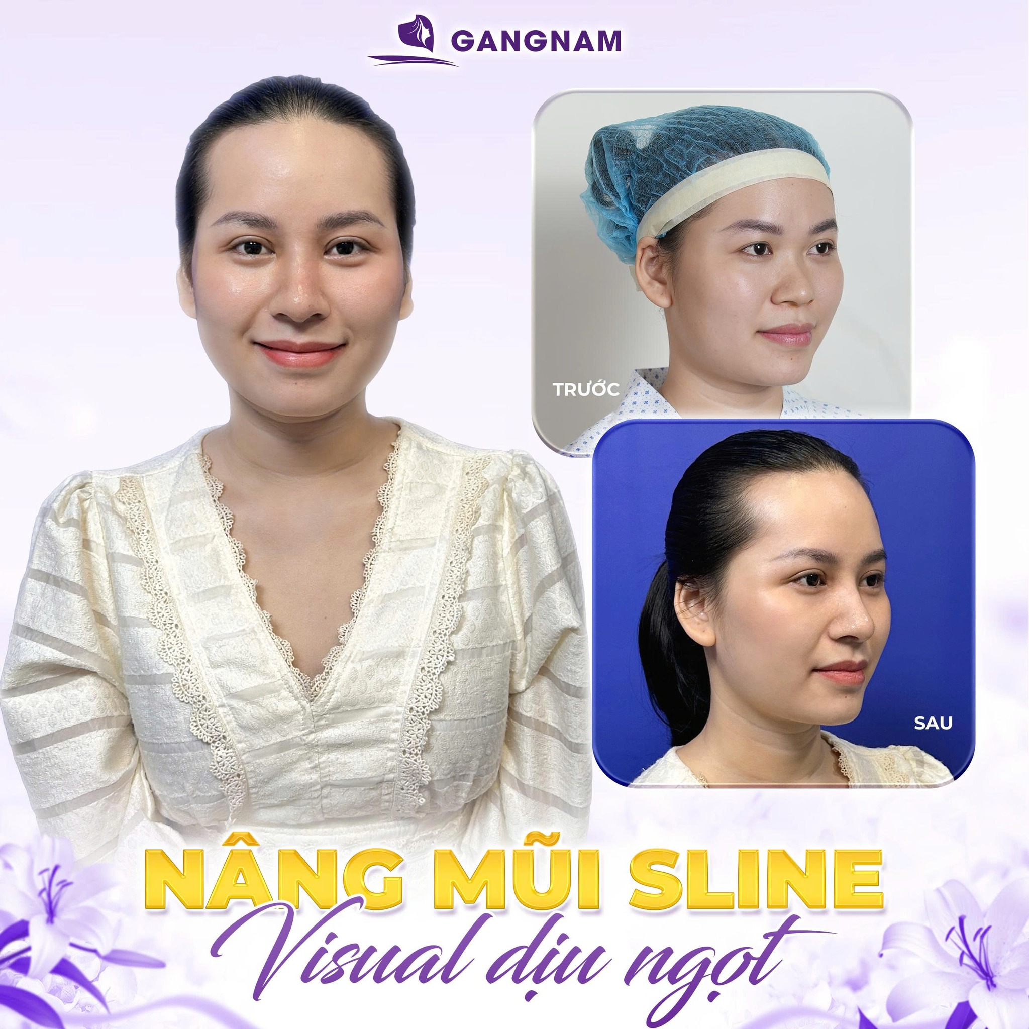 Nâng mũi Sline thẩm mỹ: Bí quyết sở hữu dáng mũi thanh thoát chuẩn tỷ lệ vàng 4 Nâng mũi Sline thẩm mỹ là gì và tại sao lại được ưa chuộng?