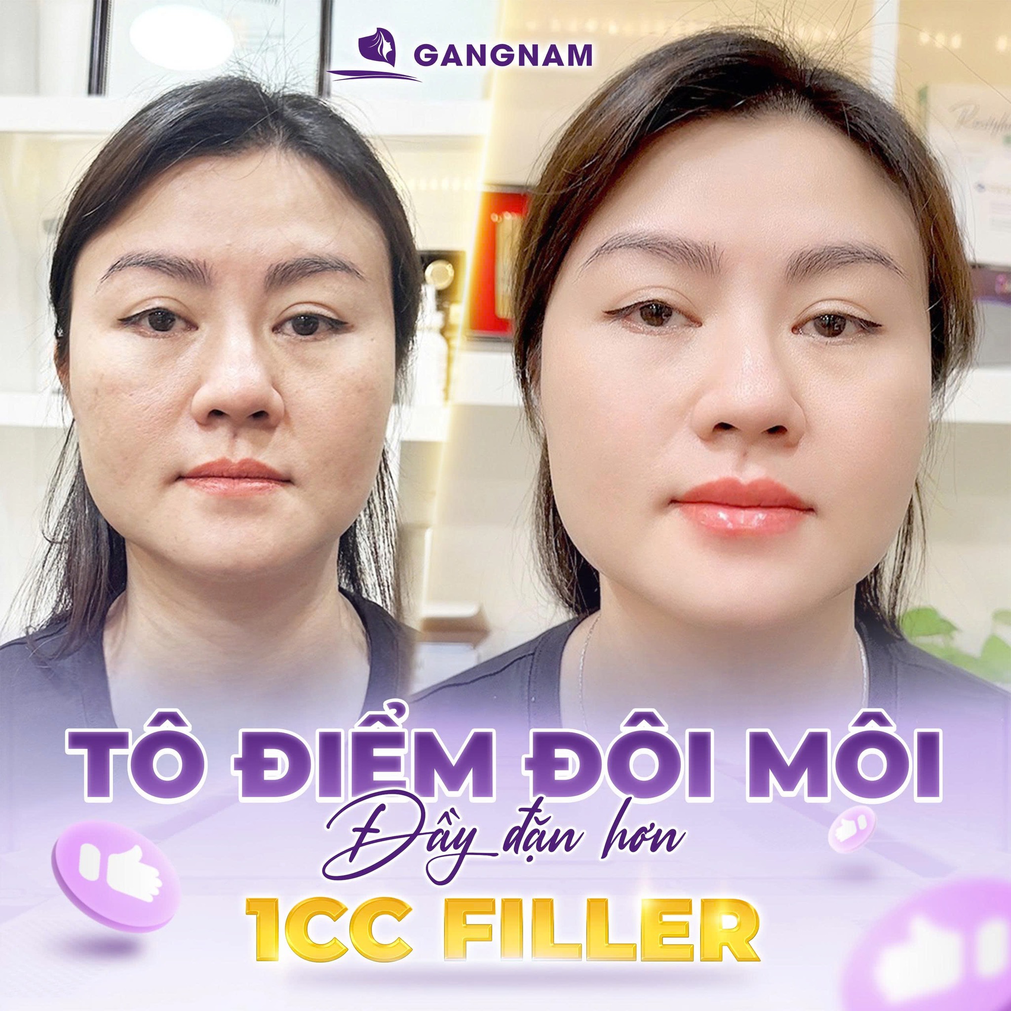 Môi căng mọng nhờ tiêm Filler – Bí quyết sở hữu nụ cười quyến rũ tức thì 4 Lợi ích vượt trội khi sở hữu môi căng mọng nhờ tiêm Filler