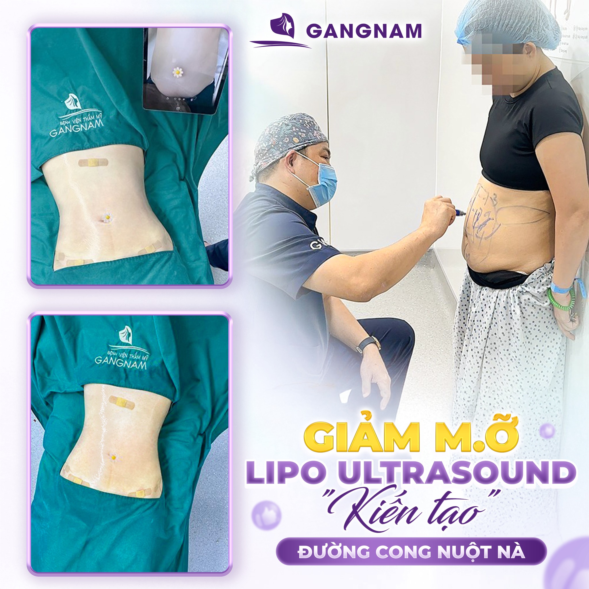 Hút mỡ vòng 2 công nghệ Lipo – Phương pháp định hình vòng eo thon gọn 6 Hút mỡ vòng 2 công nghệ Lipo tại Thẩm mỹ Gangnam