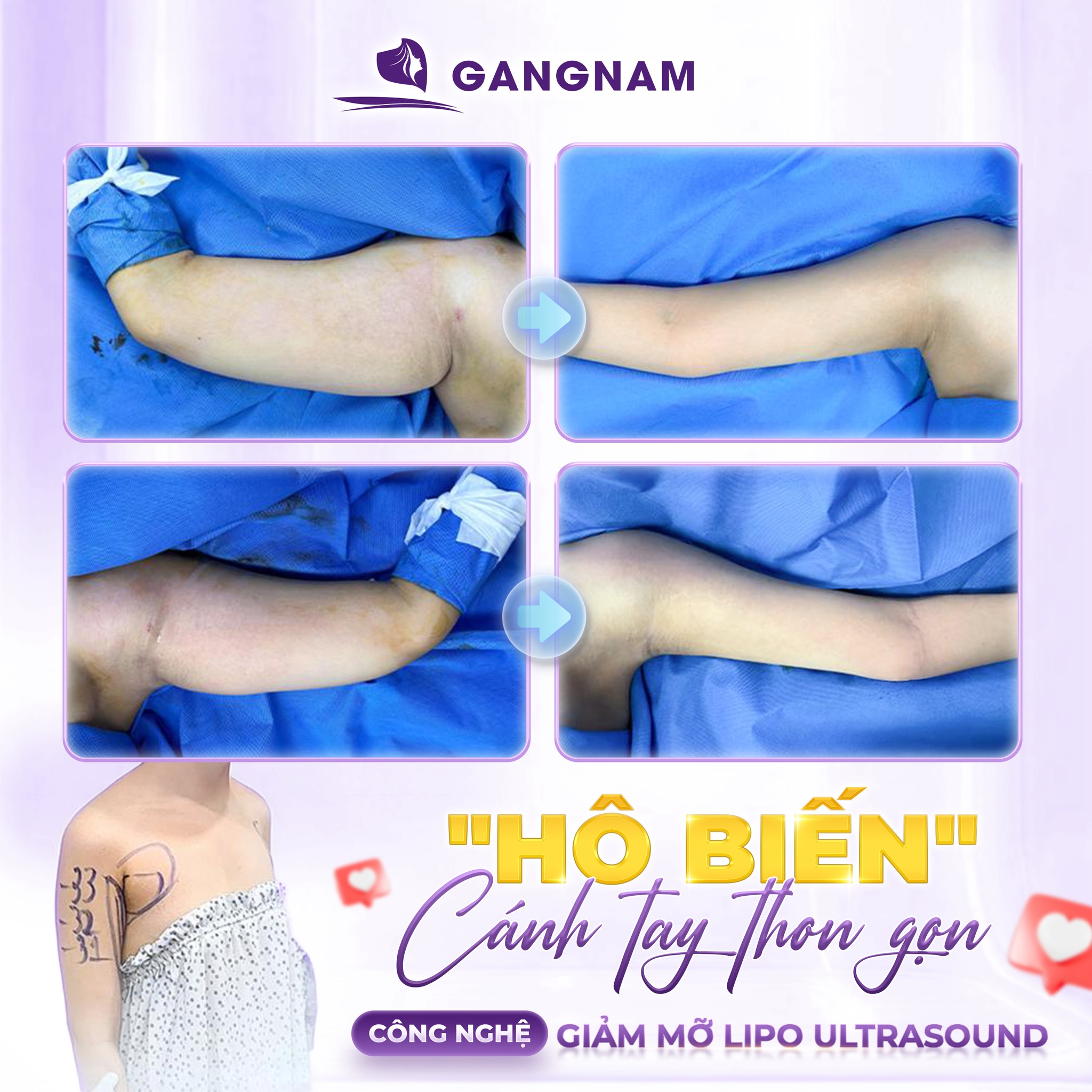 Hút mỡ thừa bắp tay: Giải pháp lấy lại vòng tay thon gọn, tự tin 6 Hút mỡ thừa bắp tay tại Thẩm mỹ Gangnam – Kiến tạo cánh tay thon gọn, săn chắc