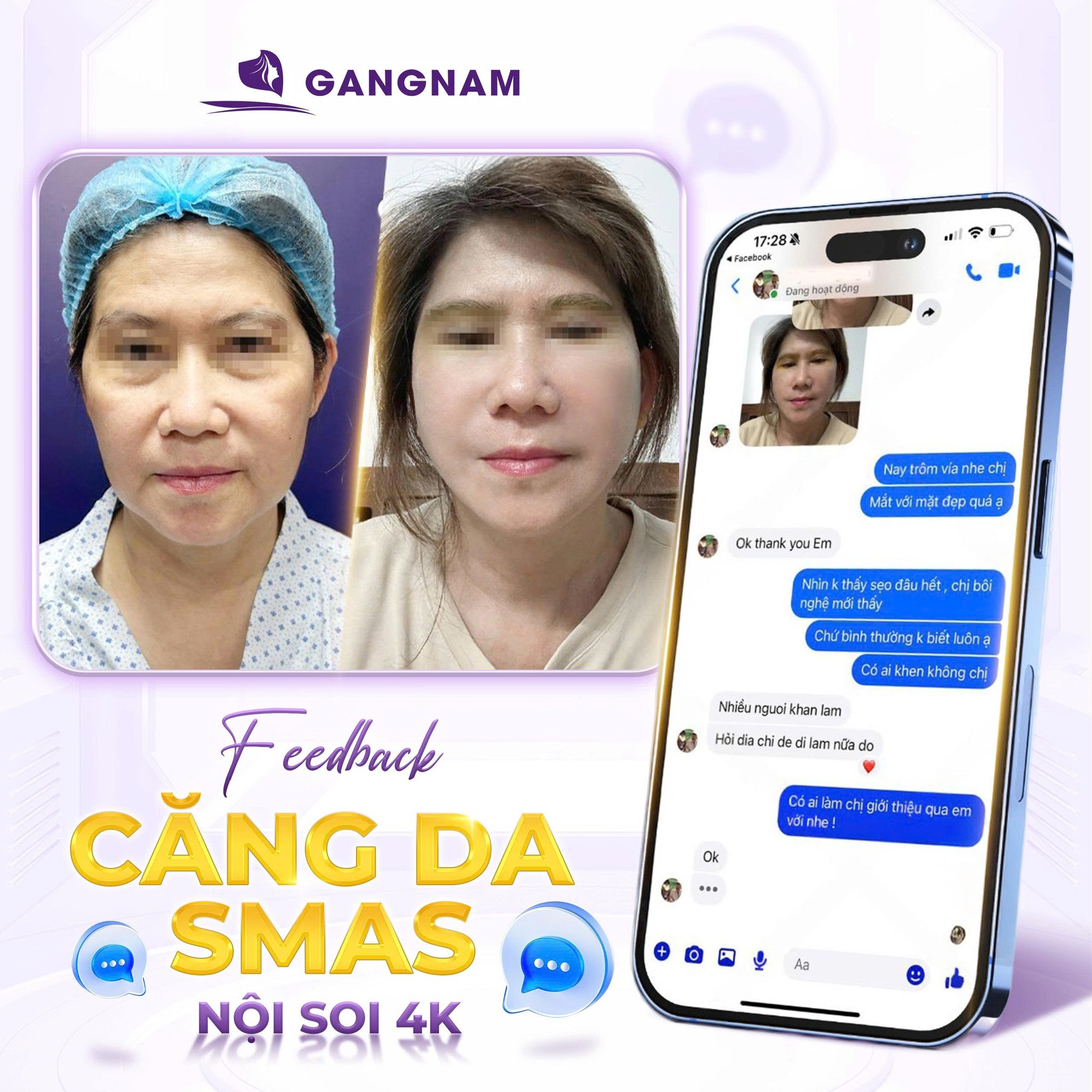 Căng Da Mặt SMAS 4K Nội Soi – Giải Pháp Trẻ Hóa Chuyên Sâu, Hiệu Quả 4 Căng da mặt SMAS 4K nội soi là gì?