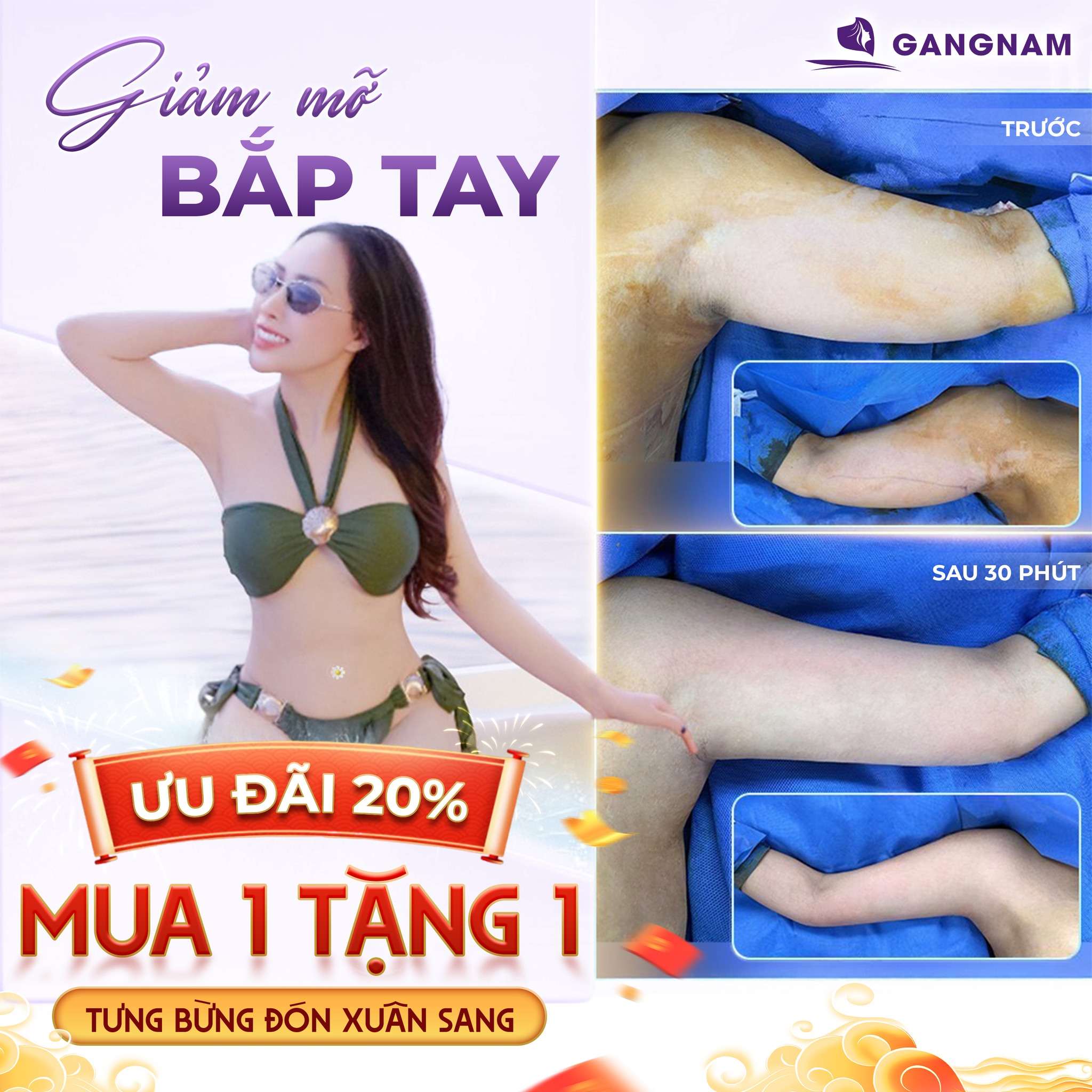 Hút mỡ thừa bắp tay: Giải pháp lấy lại vòng tay thon gọn, tự tin 4 Hút mỡ thừa bắp tay là gì và tại sao nó được ưa chuộng?