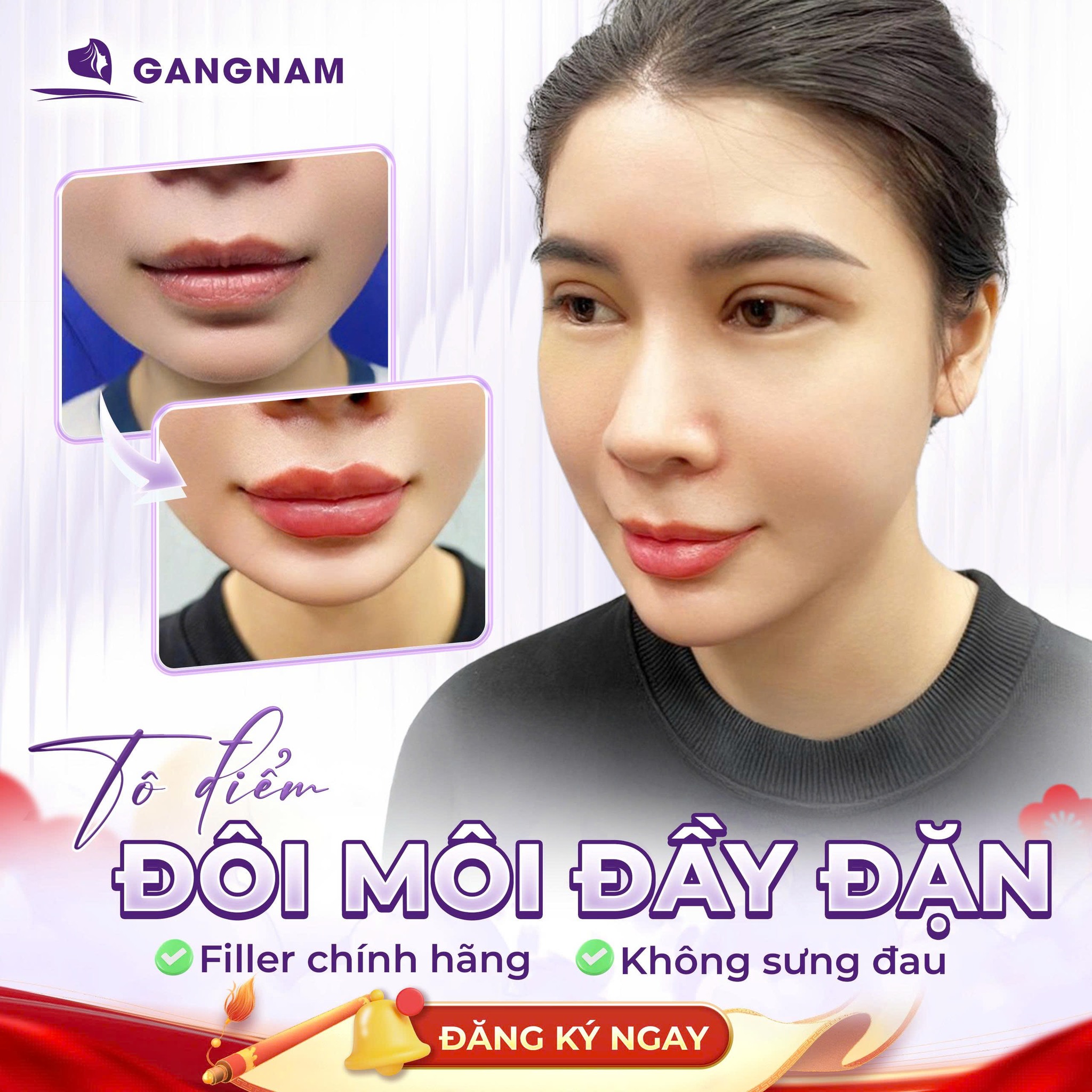 Môi căng mọng nhờ tiêm Filler – Bí quyết sở hữu nụ cười quyến rũ tức thì 6 Môi căng mọng nhờ tiêm Filler tại Thẩm mỹ Gangnam