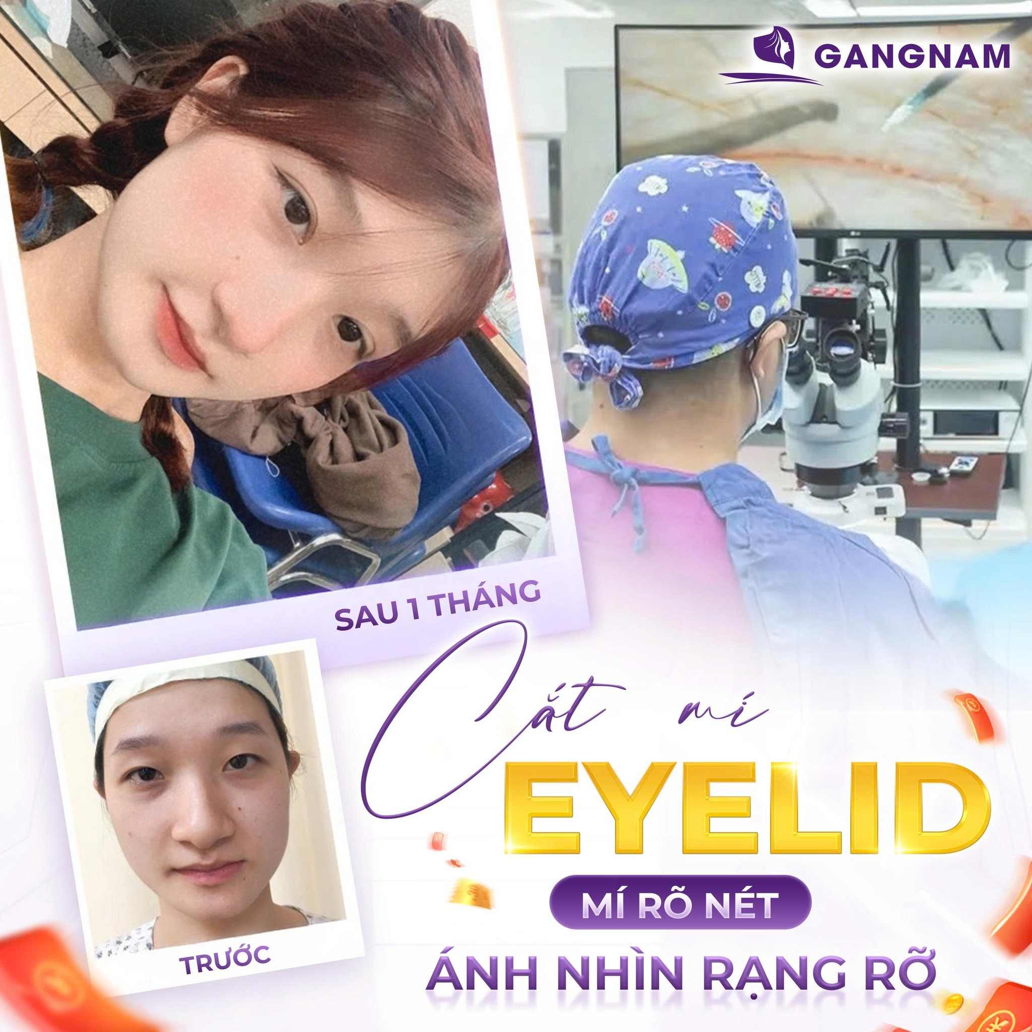 Cắt mí trên Eyelid – Giải pháp hoàn hảo cho đôi mắt trẻ trung, tự nhiên 6 Địa chỉ cắt mí trên Eyelid uy tín, an toàn