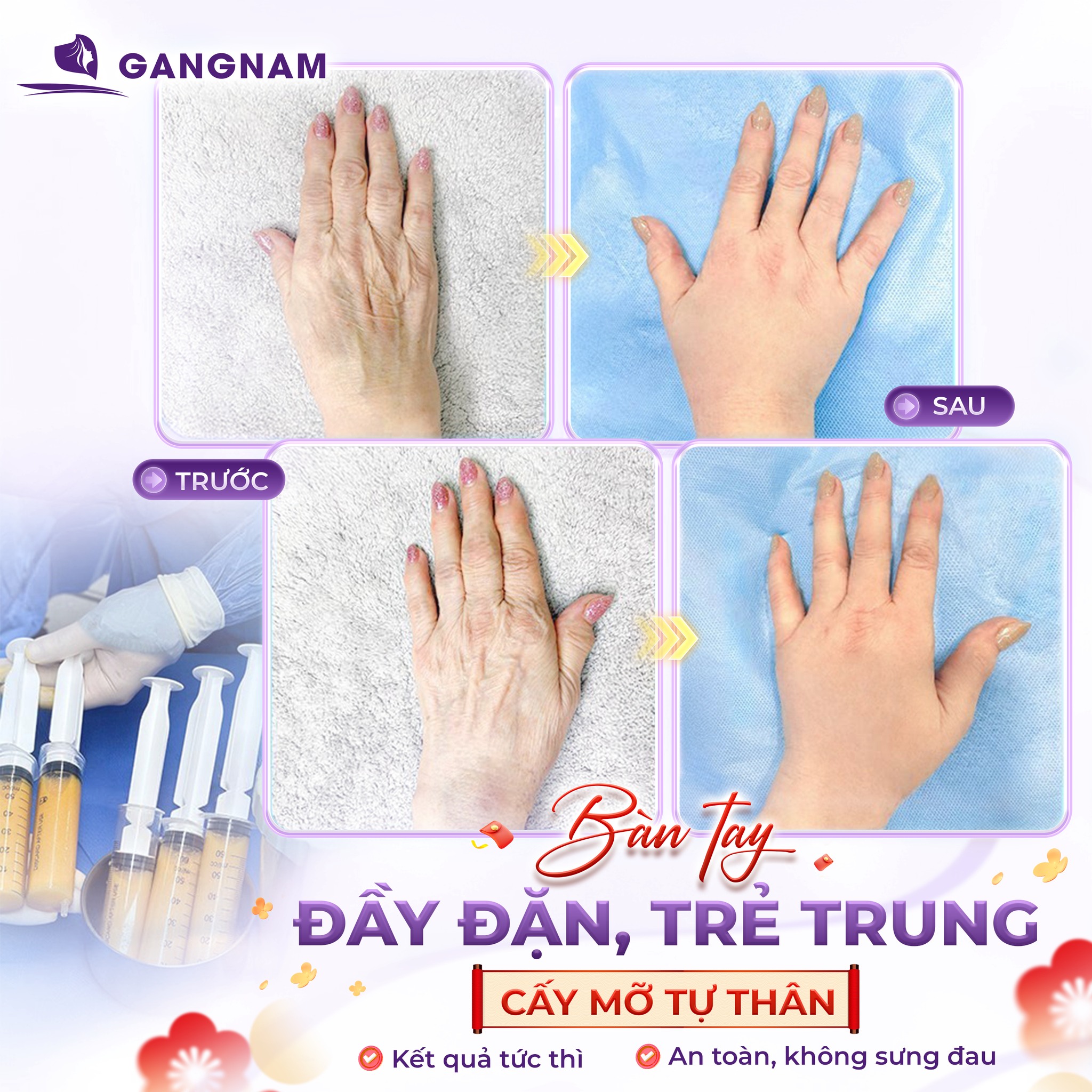 Cấy mỡ mu bàn tay tự thân – Giải pháp trẻ hóa đôi tay tự nhiên và lâu dài 5 Cấy mỡ mu bàn tay tự thân – Giải pháp trẻ hóa đôi tay tự nhiên và lâu dài 2