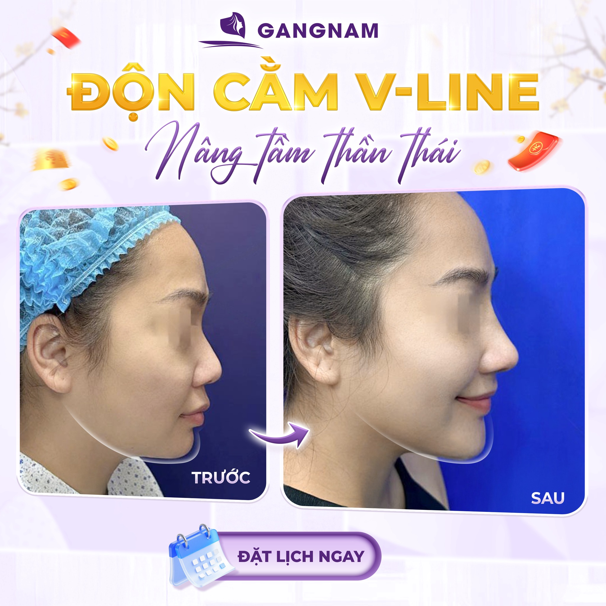 Độn Cằm Nội Soi Vline: Giải Pháp Tạo Dáng Cằm Chuẩn Tỷ Lệ Vàng 6 Độn cằm nội soi Vline tại Thẩm mỹ Gangnam