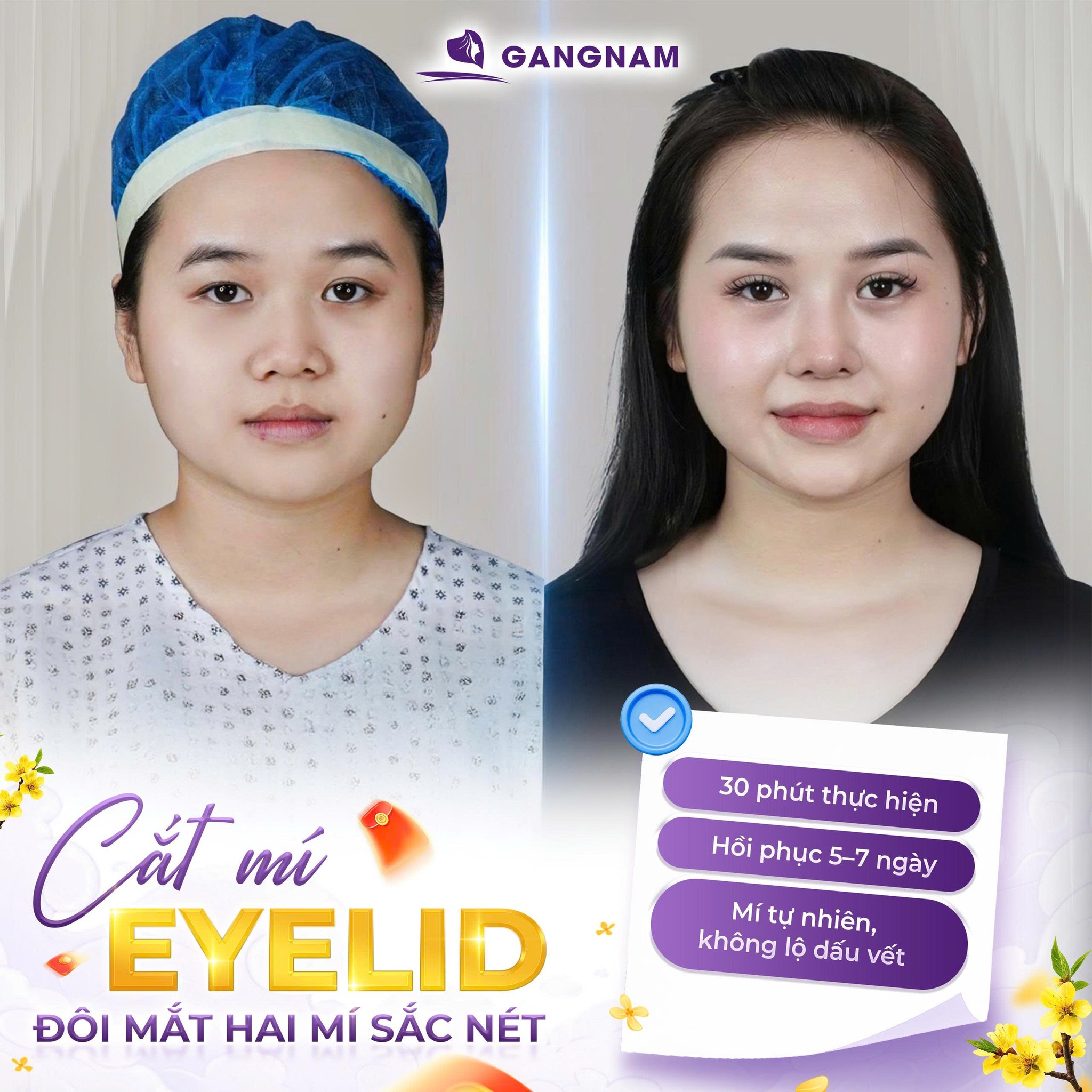 Cắt mí trên Eyelid – Giải pháp hoàn hảo cho đôi mắt trẻ trung, tự nhiên 4 Cắt mí trên Eyelid là gì?