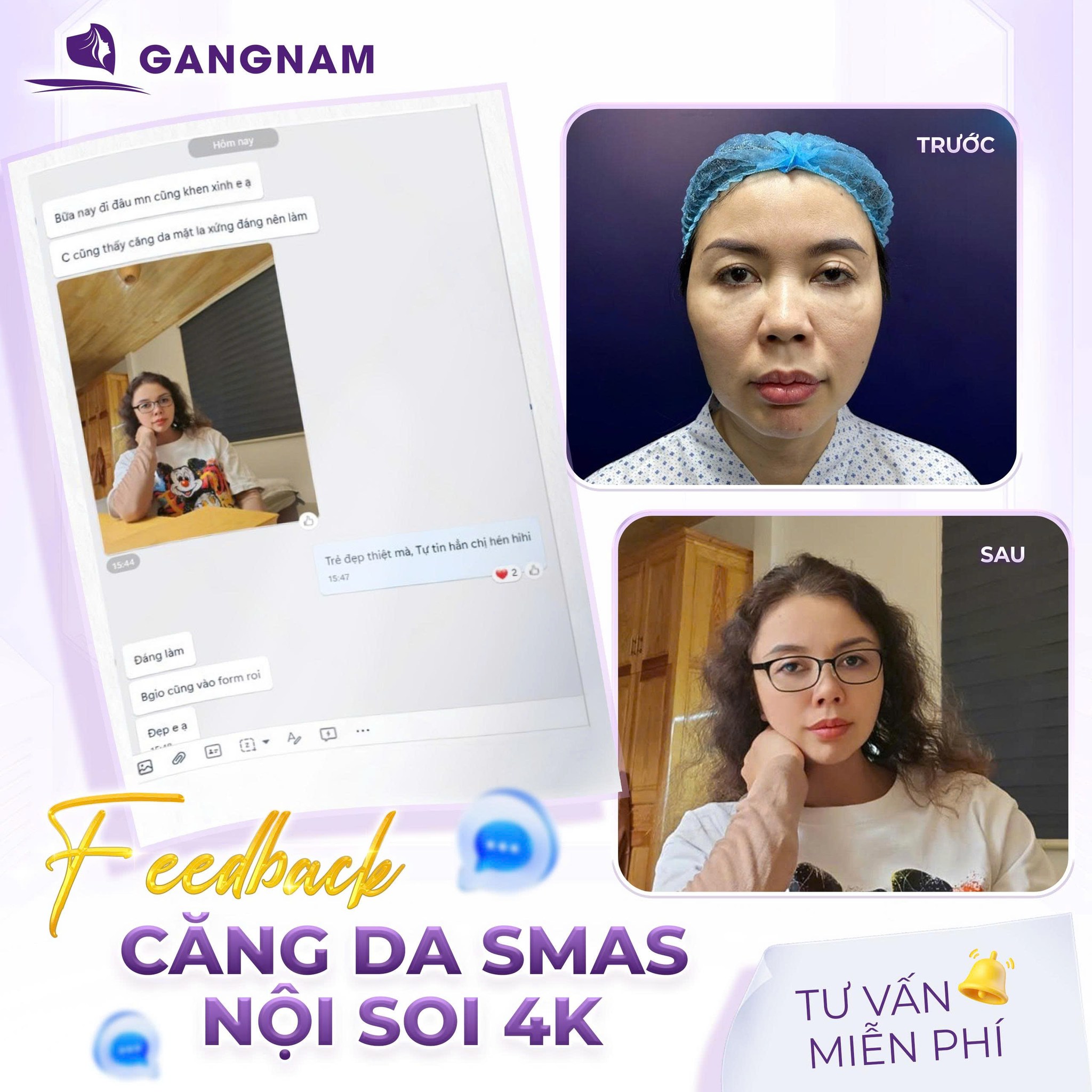 Căng Da Mặt SMAS 4K Nội Soi – Giải Pháp Trẻ Hóa Chuyên Sâu, Hiệu Quả 5 So sánh căng da mặt SMAS 4K nội soi với các phương pháp khác