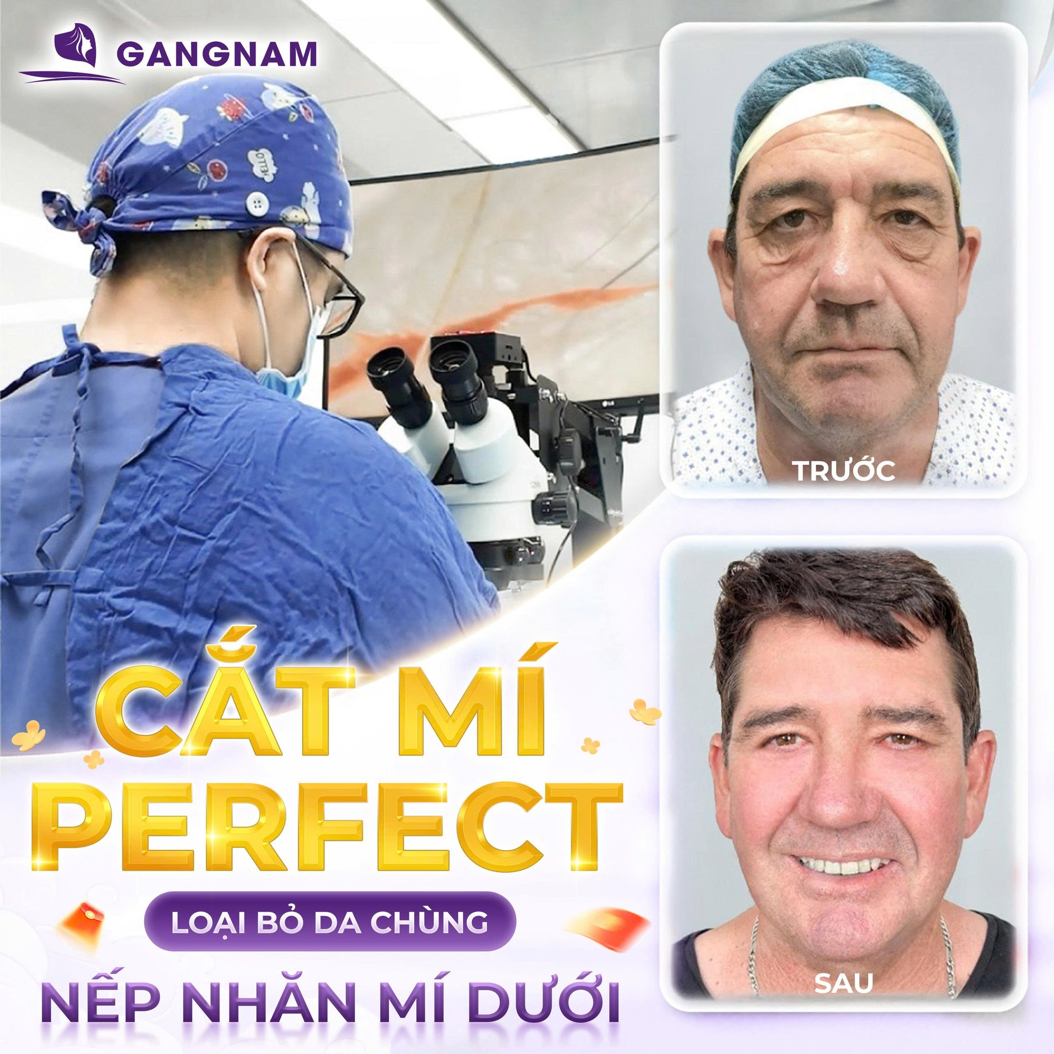 Bấm Mí Perfect – Giải Pháp Tạo Mí Đa Điểm Hiện Đại Cho Đôi Mắt Tự Nhiên 6 Bấm mí Perfect tại Thẩm mỹ Gangnam