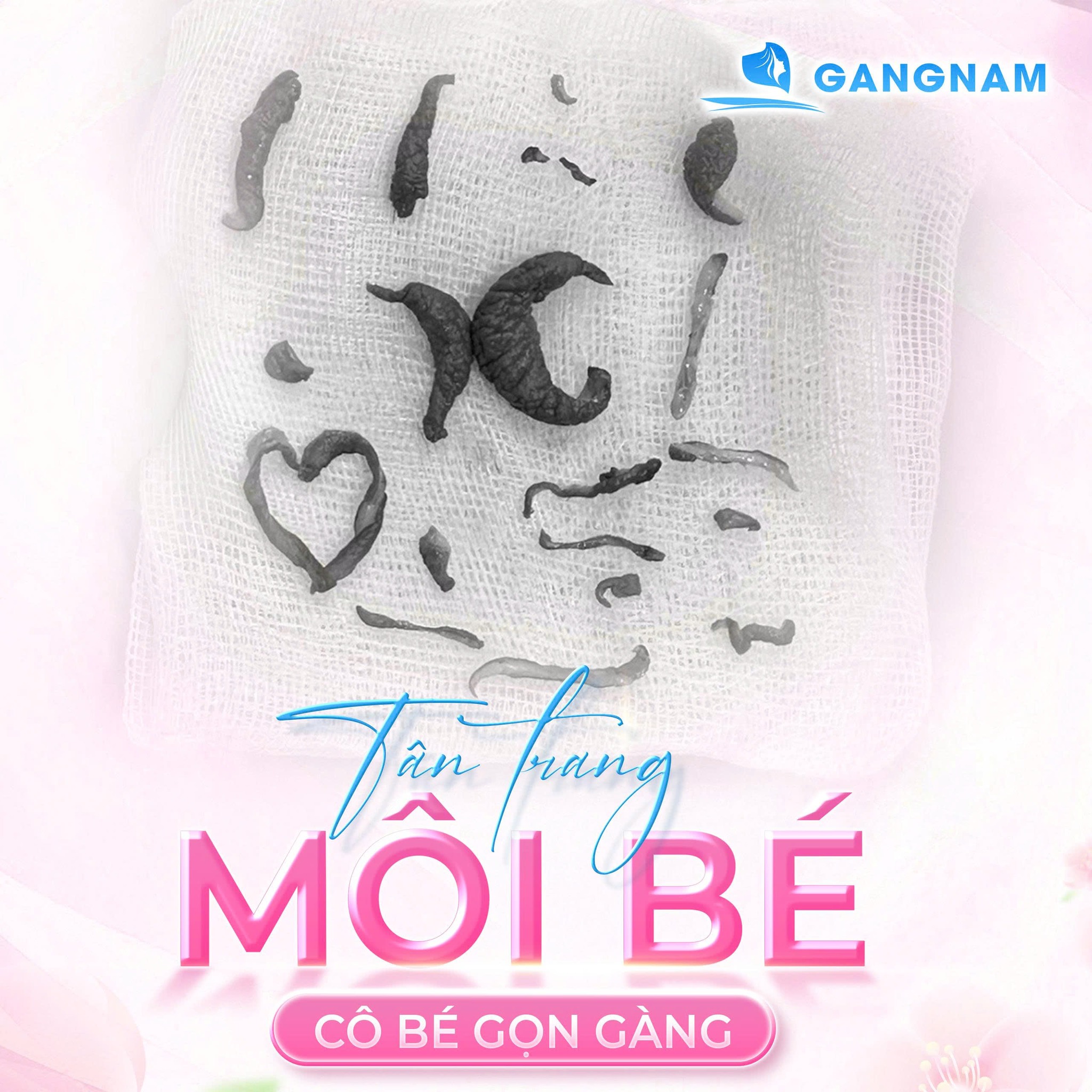 Thu Gọn Môi Cô Bé: Giải Pháp Thẩm Mỹ An Toàn, Tự Nhiên Và Cải Thiện 4 Thu gọn môi cô bé là gì