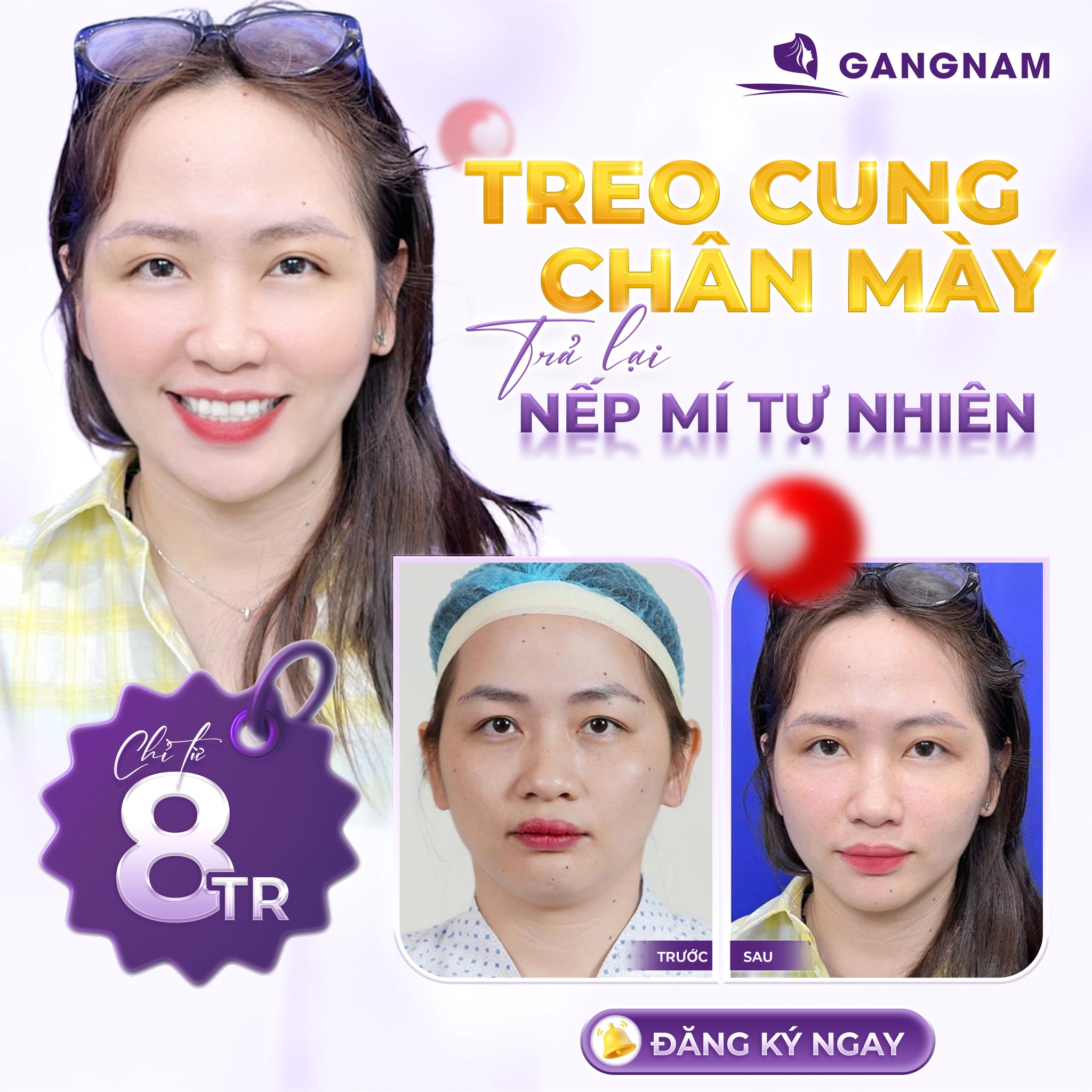Treo cung chân mày – Giải pháp trẻ hóa đôi mắt hiệu quả và tự nhiên 6 Treo cung chân mày an toàn, thẩm mỹ tại Thẩm mỹ Gangnam