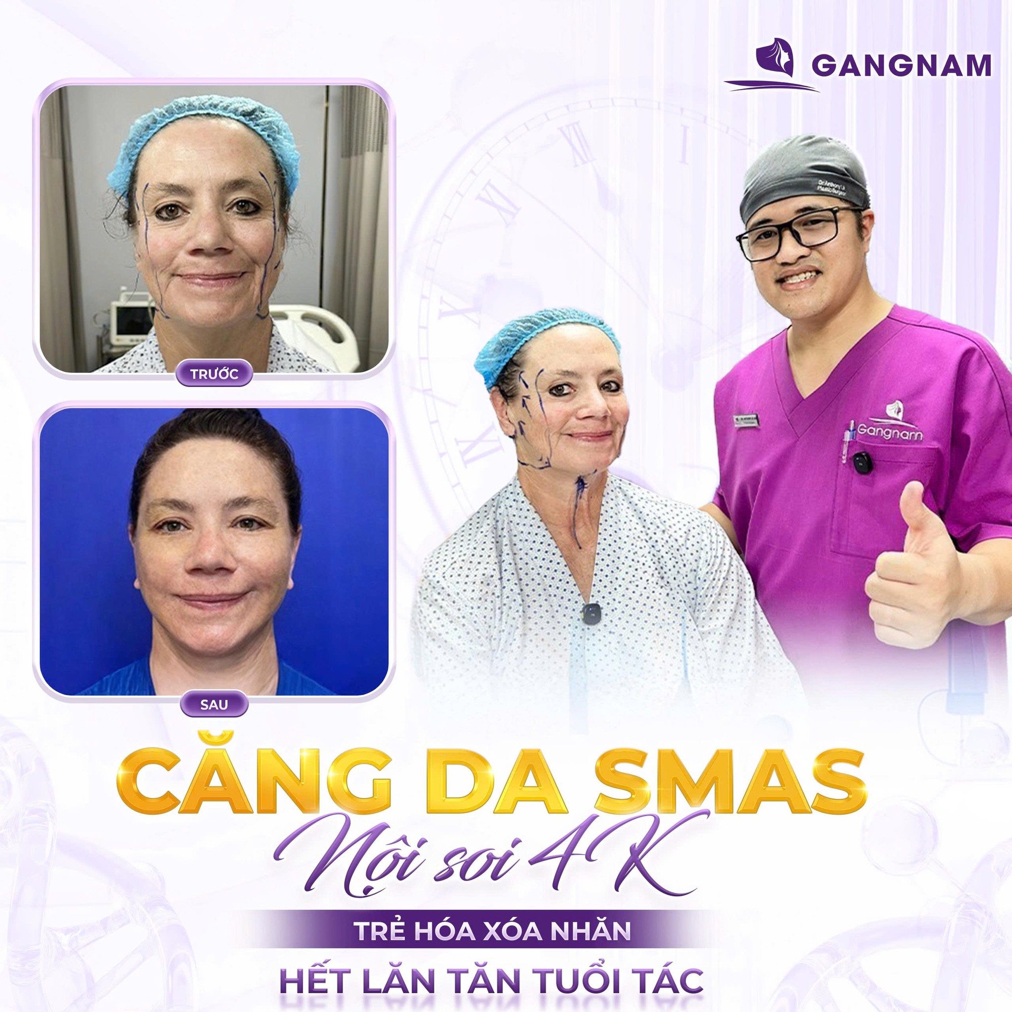 Căng Da Mặt SMAS 4K Nội Soi – Giải Pháp Trẻ Hóa Chuyên Sâu, Hiệu Quả 6 Thẩm mỹ Gangnam – Địa chỉ thực hiện căng da mặt SMAS 4K nội soi uy tín