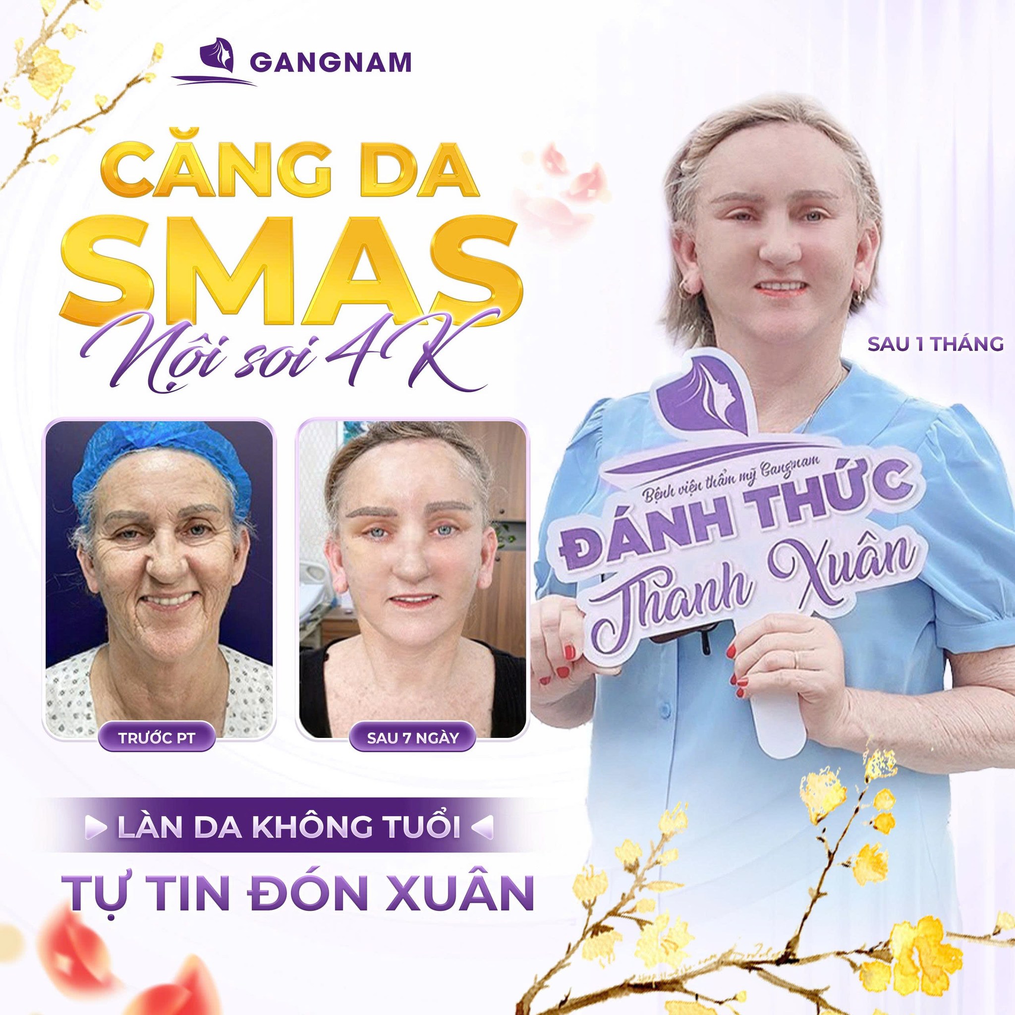 Căng da mặt nội soi 4K – Giải pháp trẻ hóa vượt trội năm 6 Địa chỉ căng da mặt nội soi 4K uy tín, an toàn