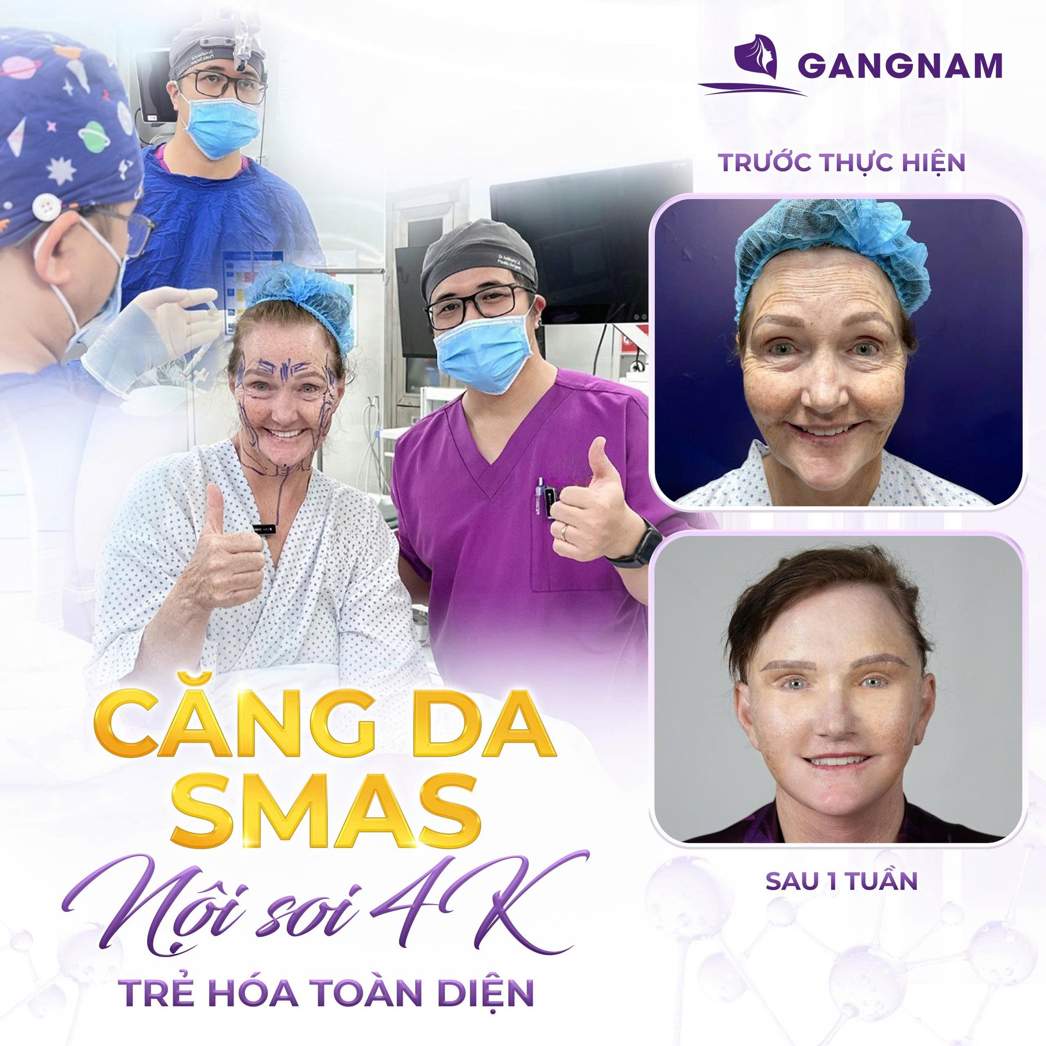 Căng da mặt nội soi 4K – Giải pháp trẻ hóa vượt trội năm 4 Căng da mặt nội soi 4K là gì và tại sao nó vượt trội