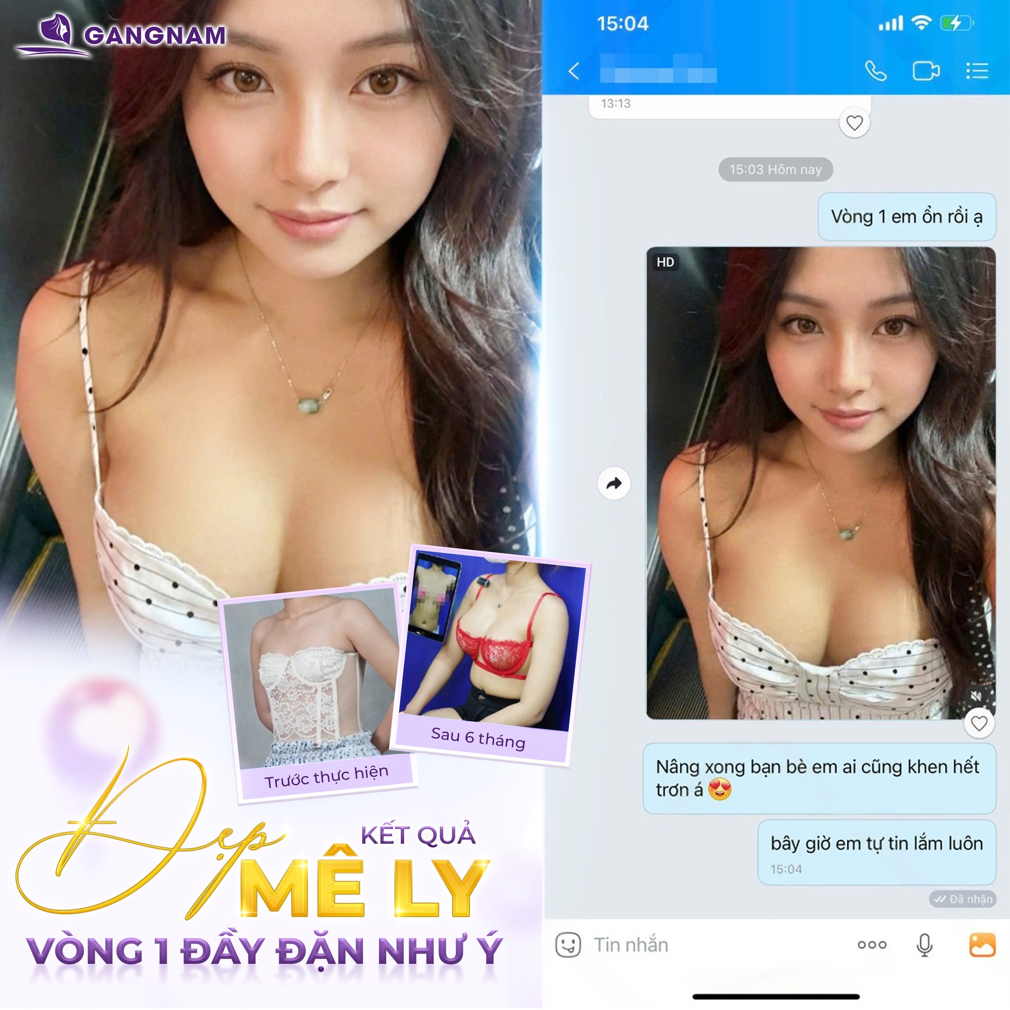 Nâng ngực đặt túi silicon: Phương pháp tăng vòng 1 an toàn, dáng ngực tự nhiên 4 Nâng ngực đặt túi silicon là gì