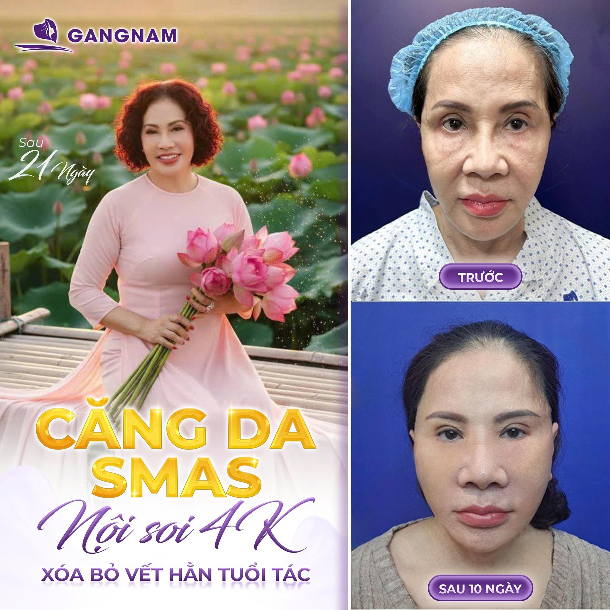 Căng da mặt nội soi 4K – Giải pháp trẻ hóa vượt trội năm 5 So sánh căng da mặt nội soi 4K với phương pháp truyền thống