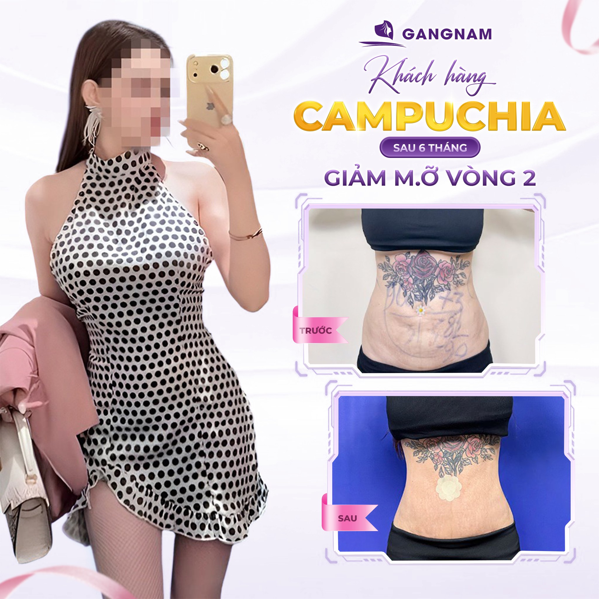 Hút mỡ vòng eo thon gọn – Giải pháp định hình vóc dáng hoàn hảo 6 Hút mỡ vòng eo thon gọn an toàn tại Thẩm mỹ Gangnam