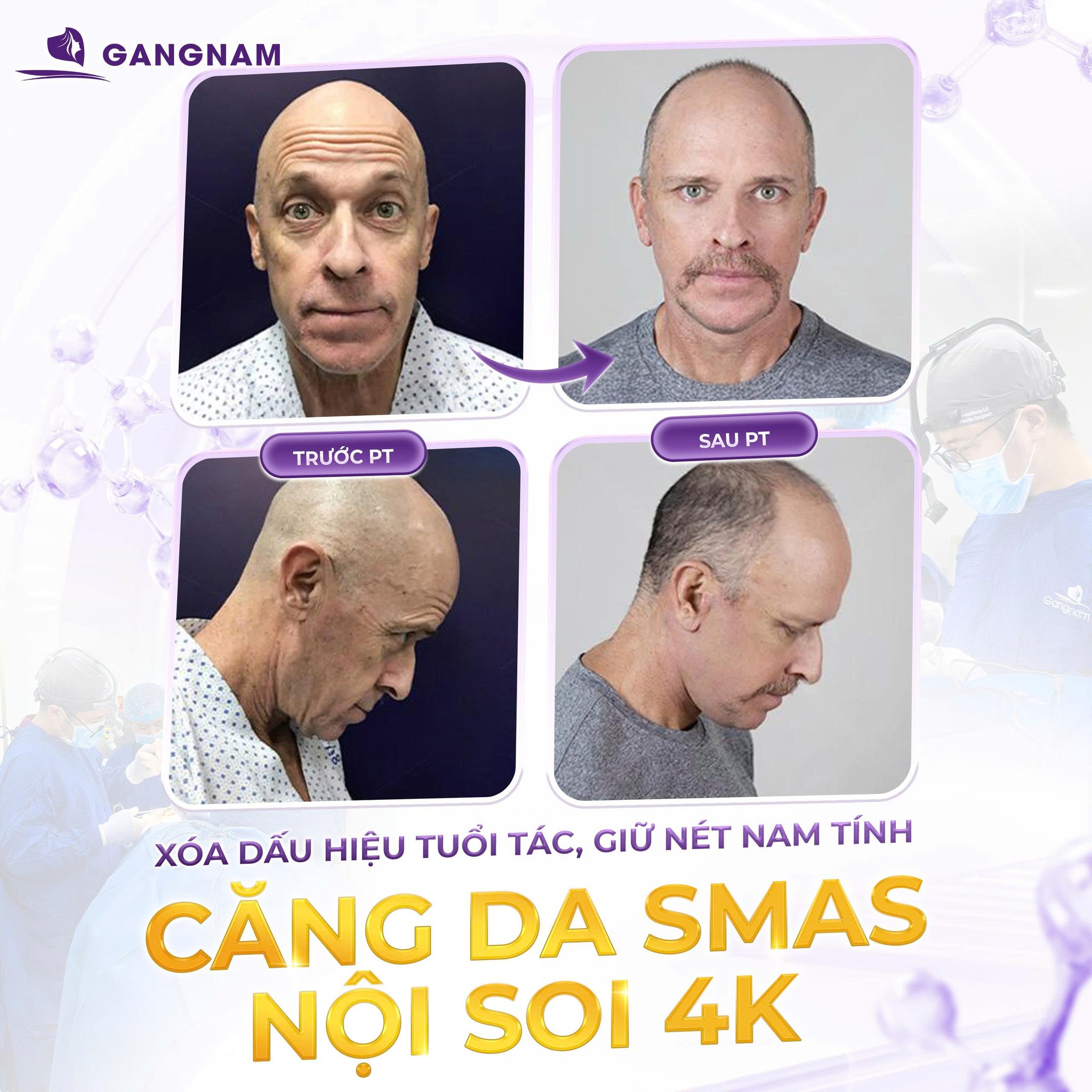 Nâng cơ mặt SMAS – Giải pháp trẻ hóa toàn diện và bền vững nhất hiện nay 6 Nâng cơ mặt SMAS an toàn tại Thẩm mỹ Gangnam