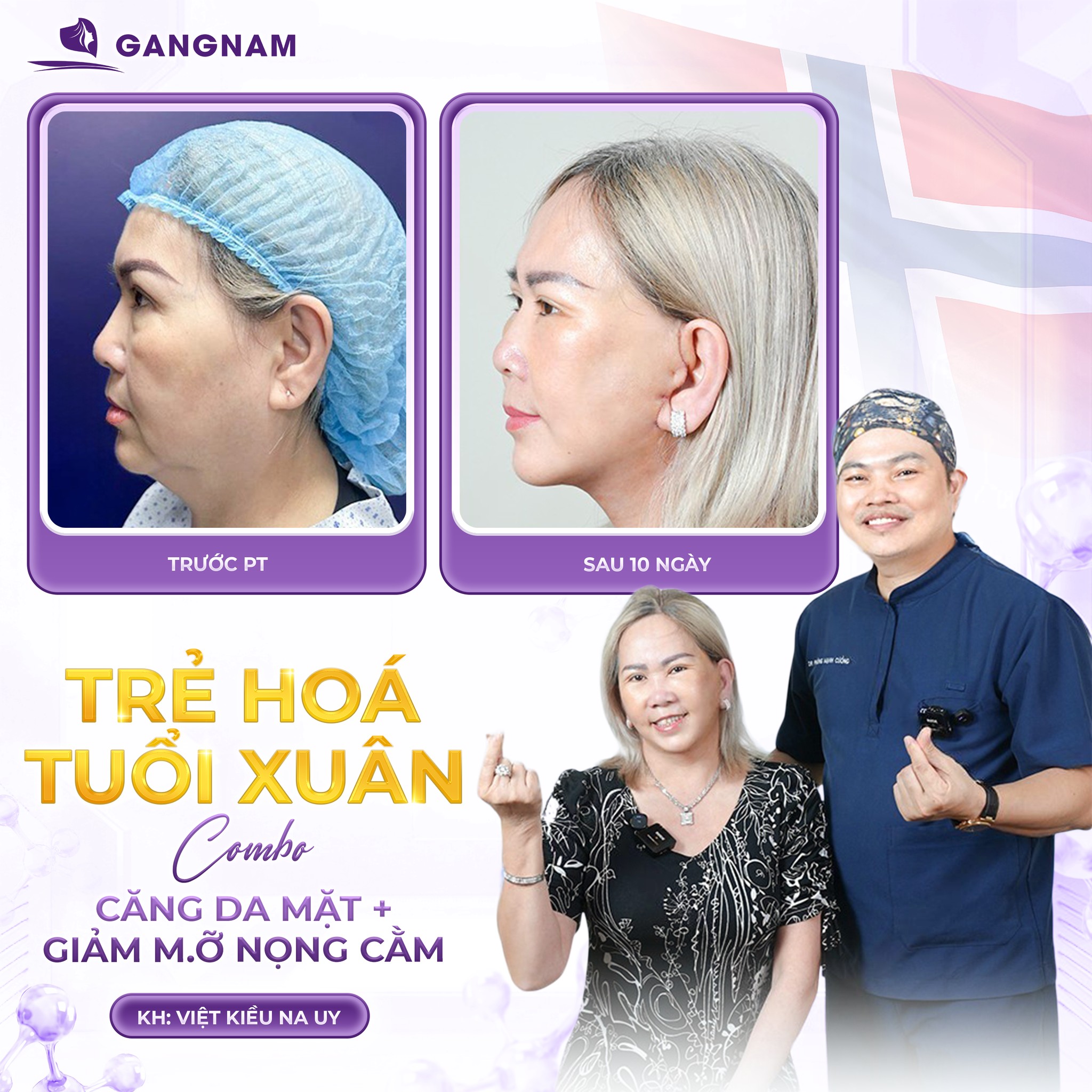 Căng da mặt nội soi – giải pháp trẻ hóa da mặt tự nhiên ít xâm lấn nhất hiện nay 4 Căng da mặt nội soi là gì và cơ chế trẻ hóa từ bên trong