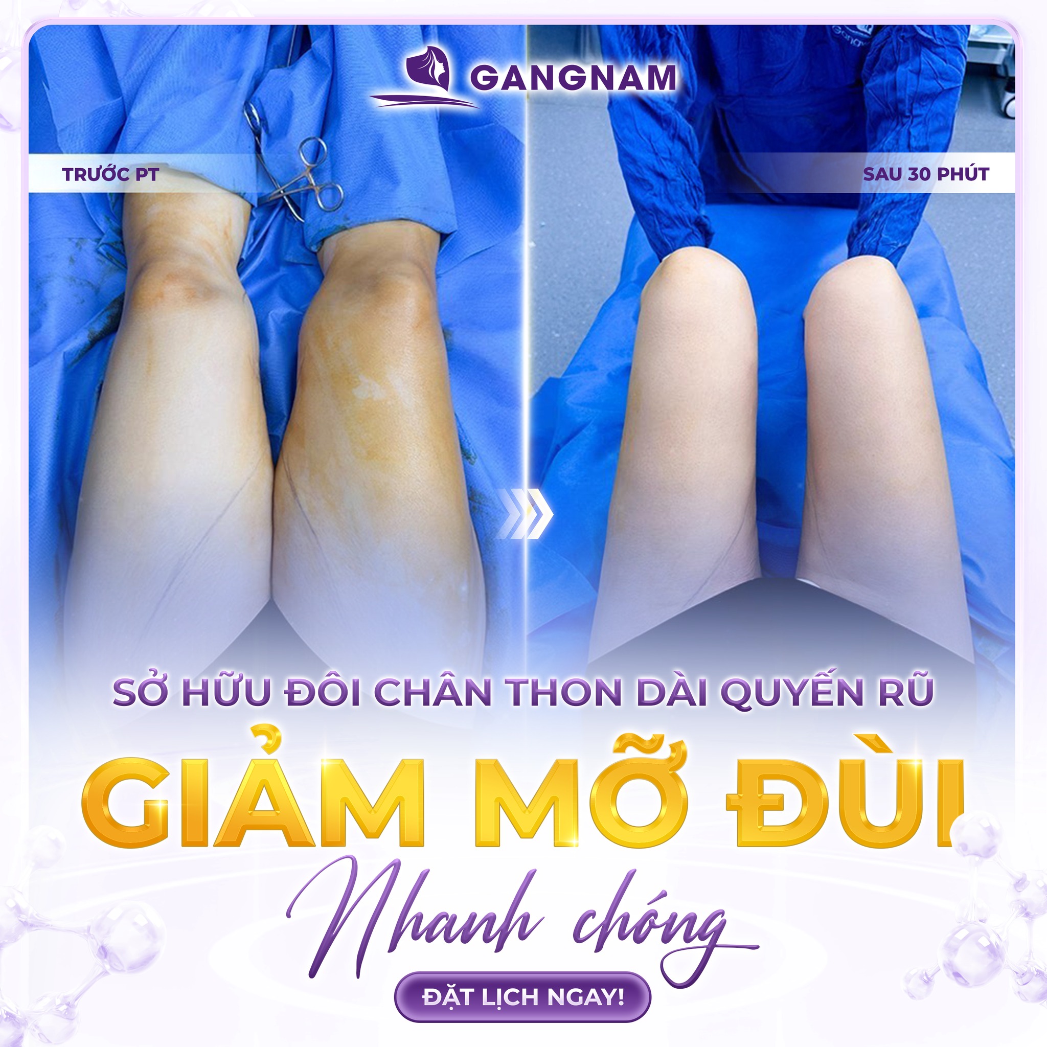 Hút mỡ đùi công nghệ Lipo: Giải pháp giảm mỡ an toàn, tạo dáng chân thon gọn 6 Hút mỡ đùi công nghệ Lipo an toàn, hiệu quả tại Thẩm mỹ Gangnam