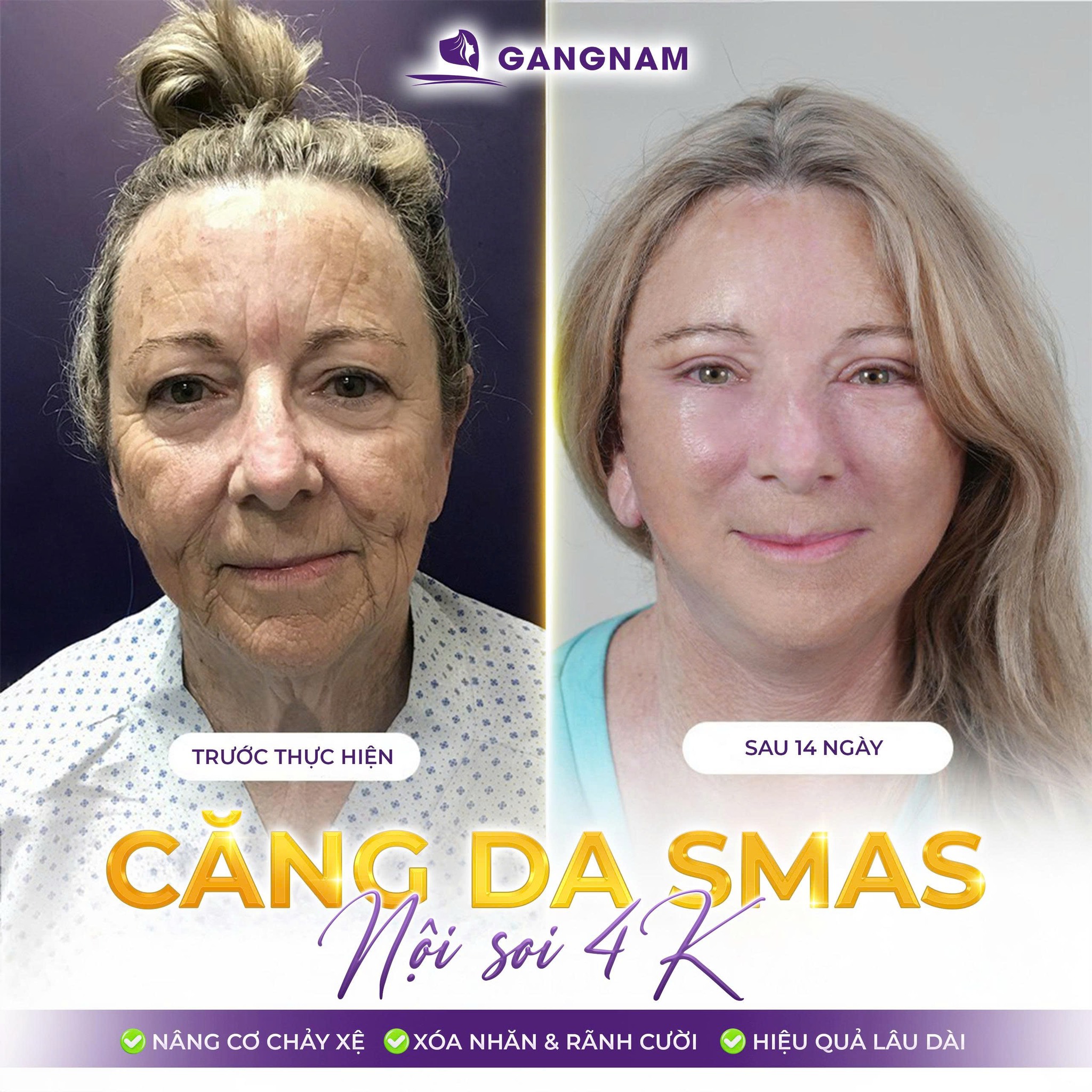 Căng da mặt nội soi – giải pháp trẻ hóa da mặt tự nhiên ít xâm lấn nhất hiện nay 5 Đối tượng phù hợp và khi nào nên chọn căng da mặt nội soi