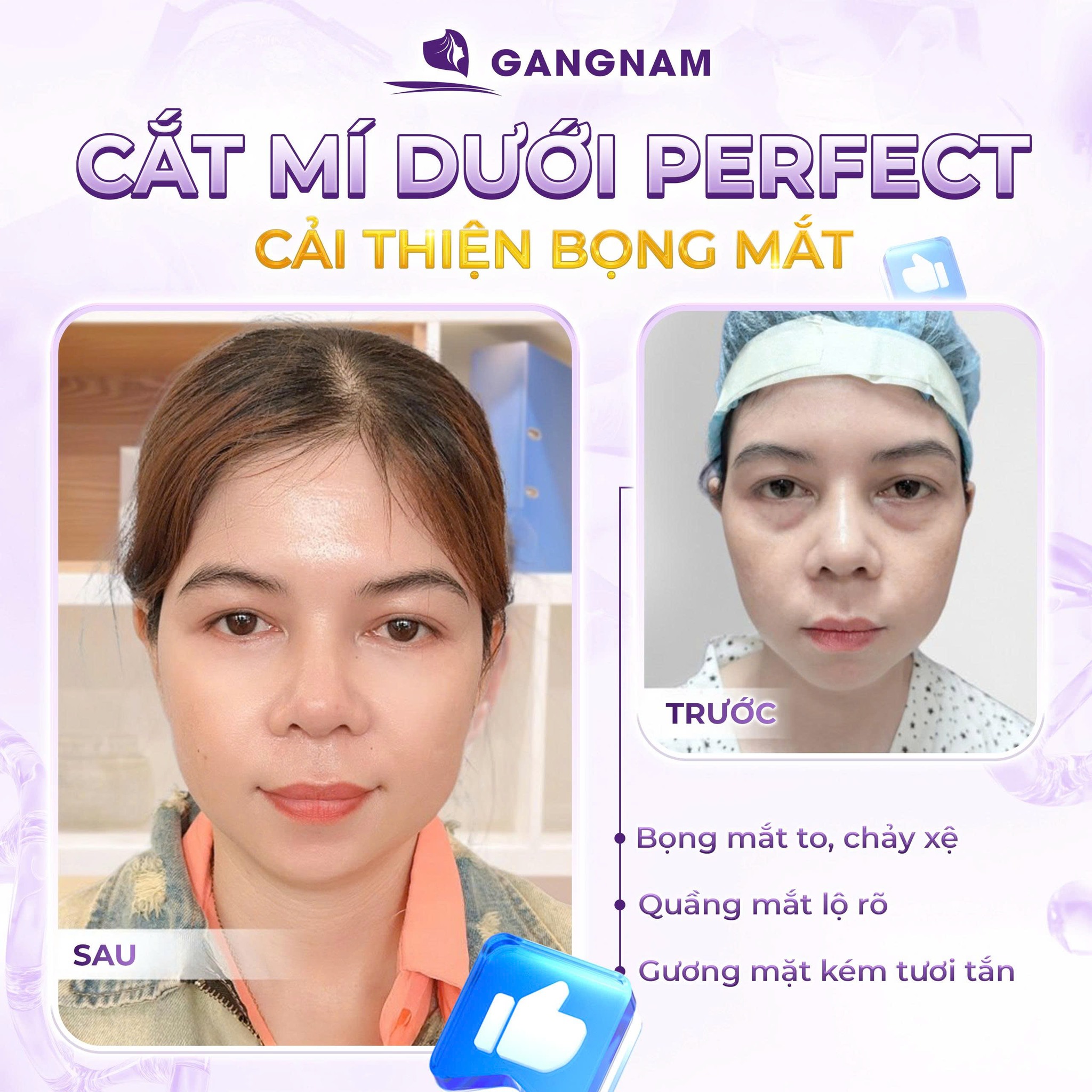 Cắt mí Perfect thẩm mỹ – phương pháp tạo mắt hai mí tự nhiên và cuốn hút 4 Cắt mí Perfect thẩm mỹ là gì và cơ chế tạo hình mắt hai mí