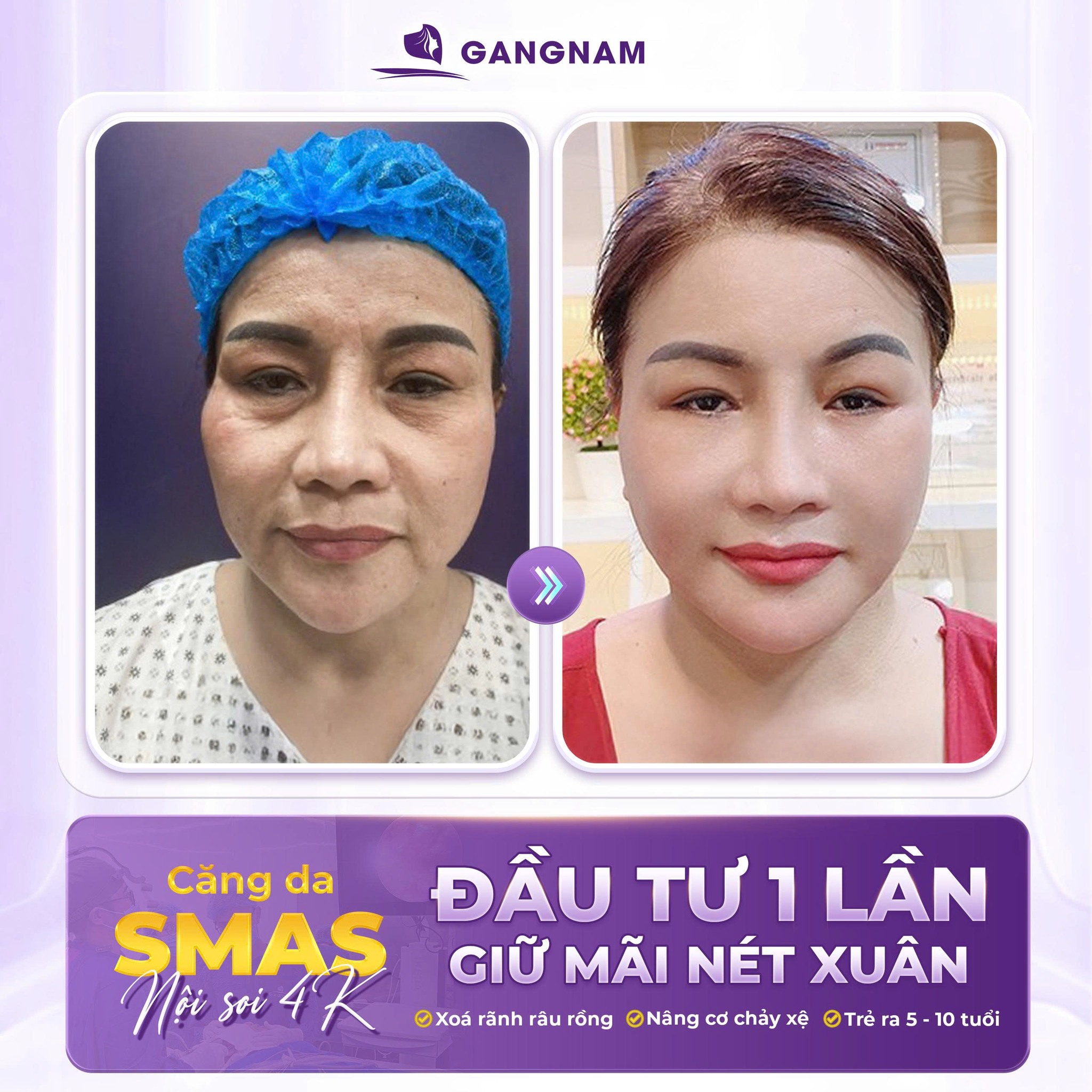 Căng da mặt cùng Dr.Anthony Lê – Giải pháp trẻ hóa toàn diện, tự nhiên 5 Quy trình thực hiện căng da mặt cùng Dr.Anthony Lê