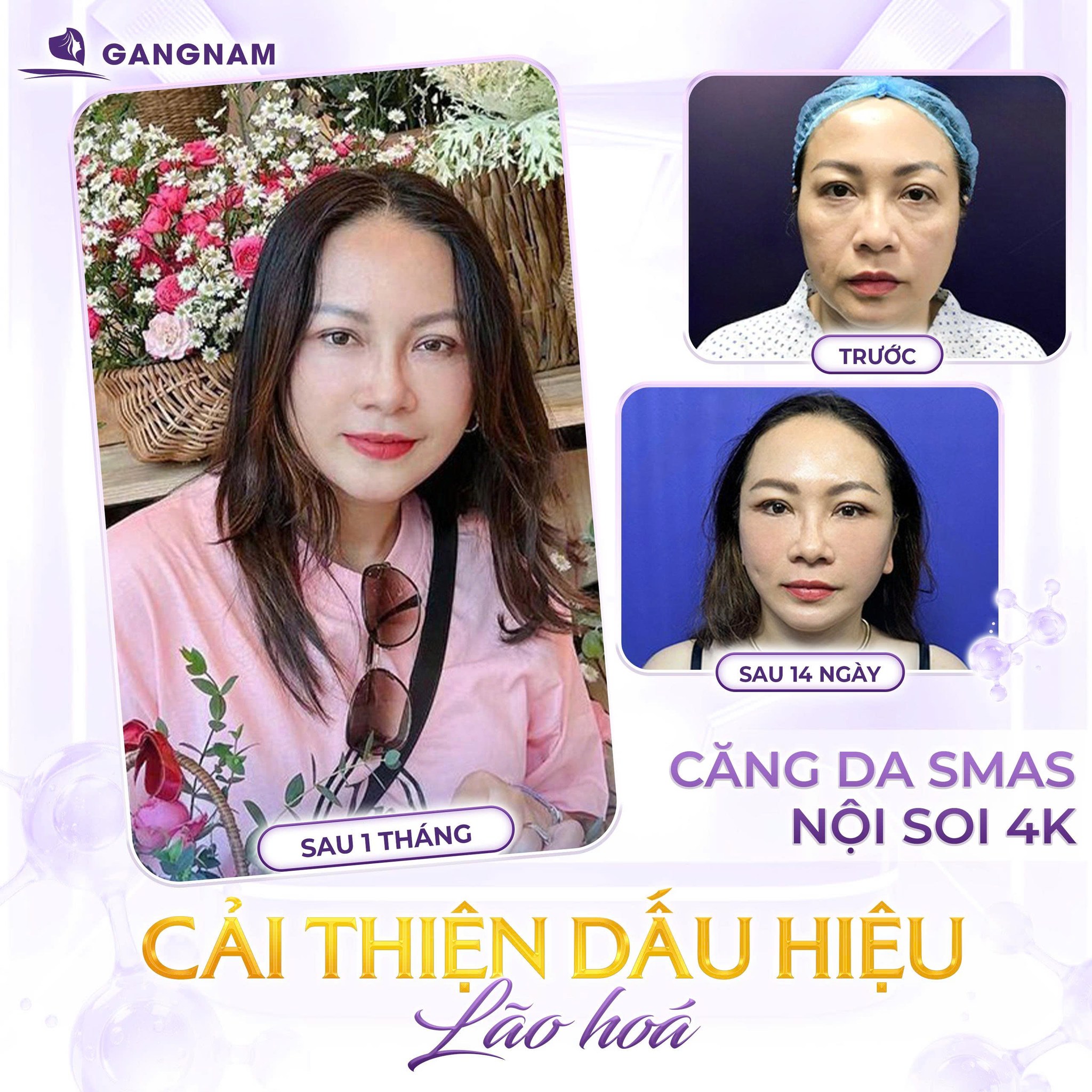 Căng da mặt cùng Dr.Anthony Lê – Giải pháp trẻ hóa toàn diện, tự nhiên 6 Căng da mặt cùng Dr.Anthony Lê
