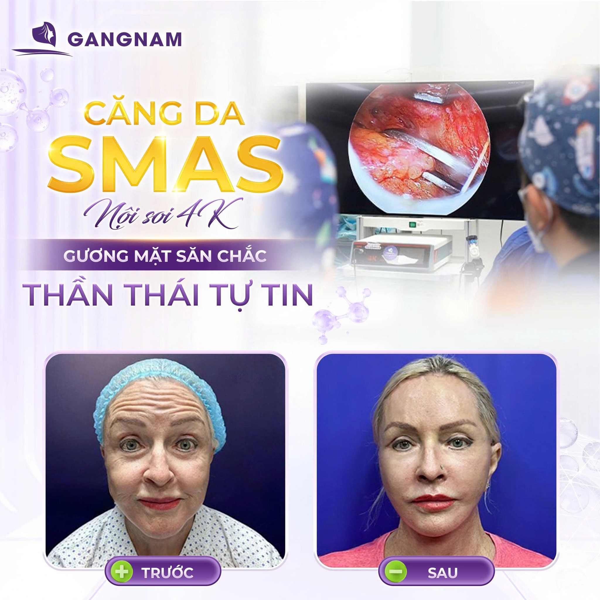 Căng da mặt cùng Dr.Anthony Lê – Giải pháp trẻ hóa toàn diện, tự nhiên 4 Căng da mặt cùng Dr.Anthony Lê là gì