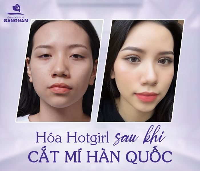 Cắt Mí Công Nghệ Hàn Quốc Là Gì? Ưu Điểm, Công Nghệ Mới 6 Cắt mí công nghệ Hàn Quốc – Giải pháp tạo đôi mắt hai mí tự nhiên