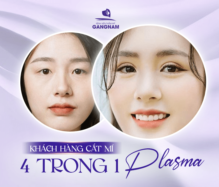 Cắt mí 4in1 thẩm mỹ: Giải pháp toàn diện cho đôi mắt đẹp tự nhiên, trẻ trung 4 Cắt mí 4in1 thẩm mỹ là gì?