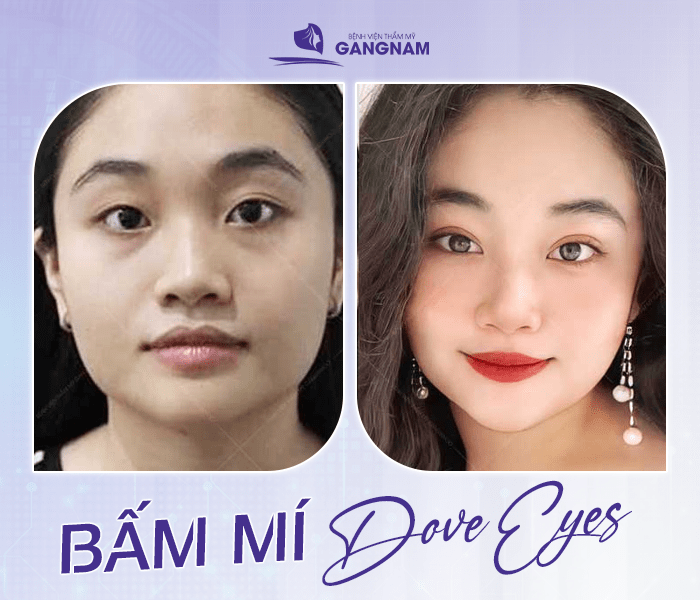 Bấm mí Dove Eyes an toàn – Giải pháp tạo mắt bồ câu tự nhiên, bền đẹp 4 Bấm mí Dove Eyes an toàn là gì?