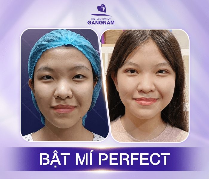Bấm Mí Perfect – Giải Pháp Tạo Mí Đa Điểm Hiện Đại Cho Đôi Mắt Tự Nhiên 5 Quy trình thực hiện và thời gian hồi phục sau Bấm mí Perfect