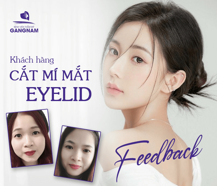 Cắt mí trên Eyelid tự nhiên – giải pháp trẻ hóa đôi mắt thanh thoát và hài hòa 6 Cắt mí trên Eyelid tự nhiên tại Thẩm mỹ Gangnam