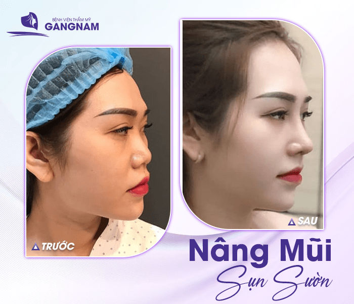 Nâng mũi sụn sườn – Giải pháp tái cấu trúc mũi toàn diện và bền vững 4 Nâng mũi sụn sườn – Giải pháp tái cấu trúc mũi toàn diện và bền vững 2