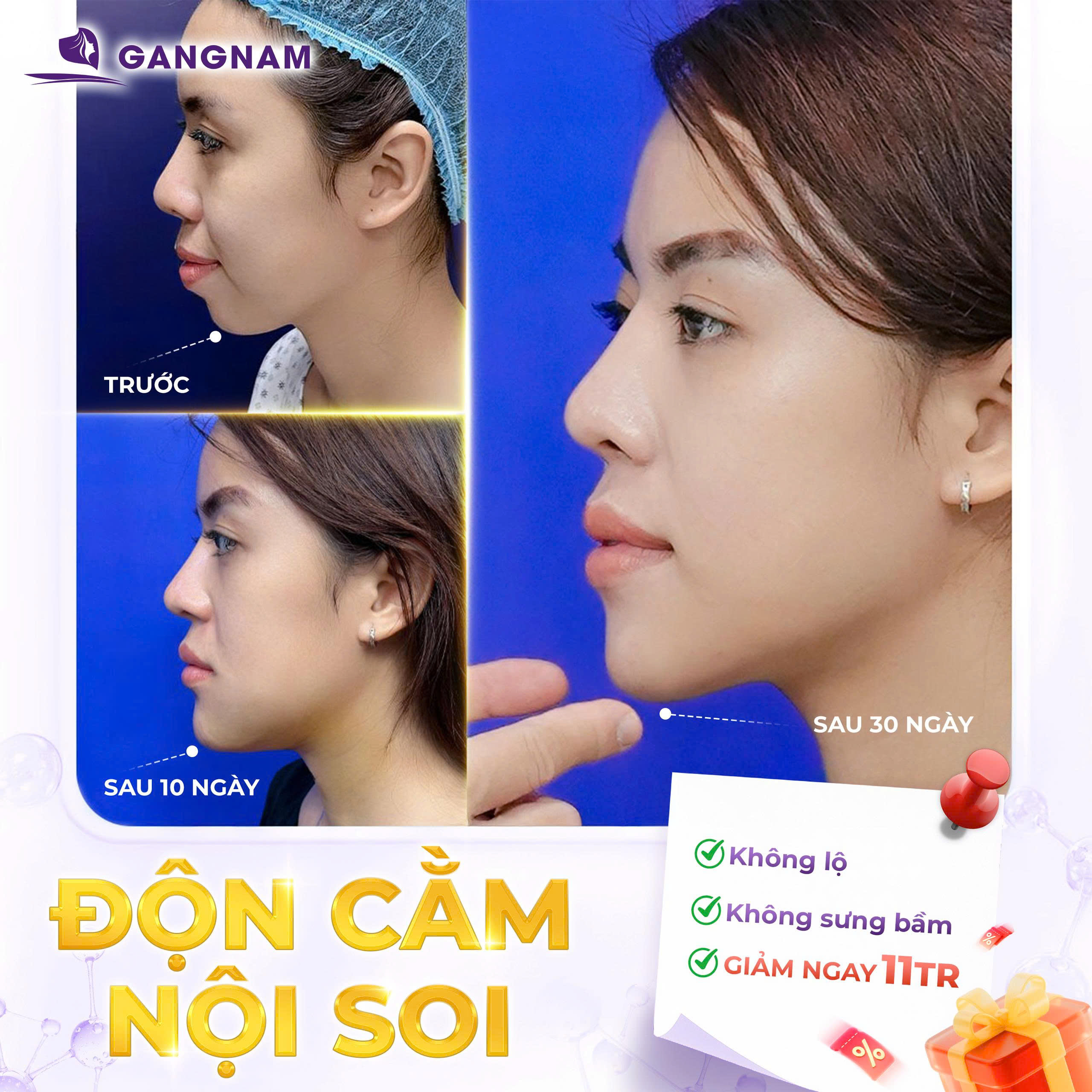 Độn Cằm Nội Soi Vline: Giải Pháp Tạo Dáng Cằm Chuẩn Tỷ Lệ Vàng 4 Độn cằm nội soi Vline là gì?