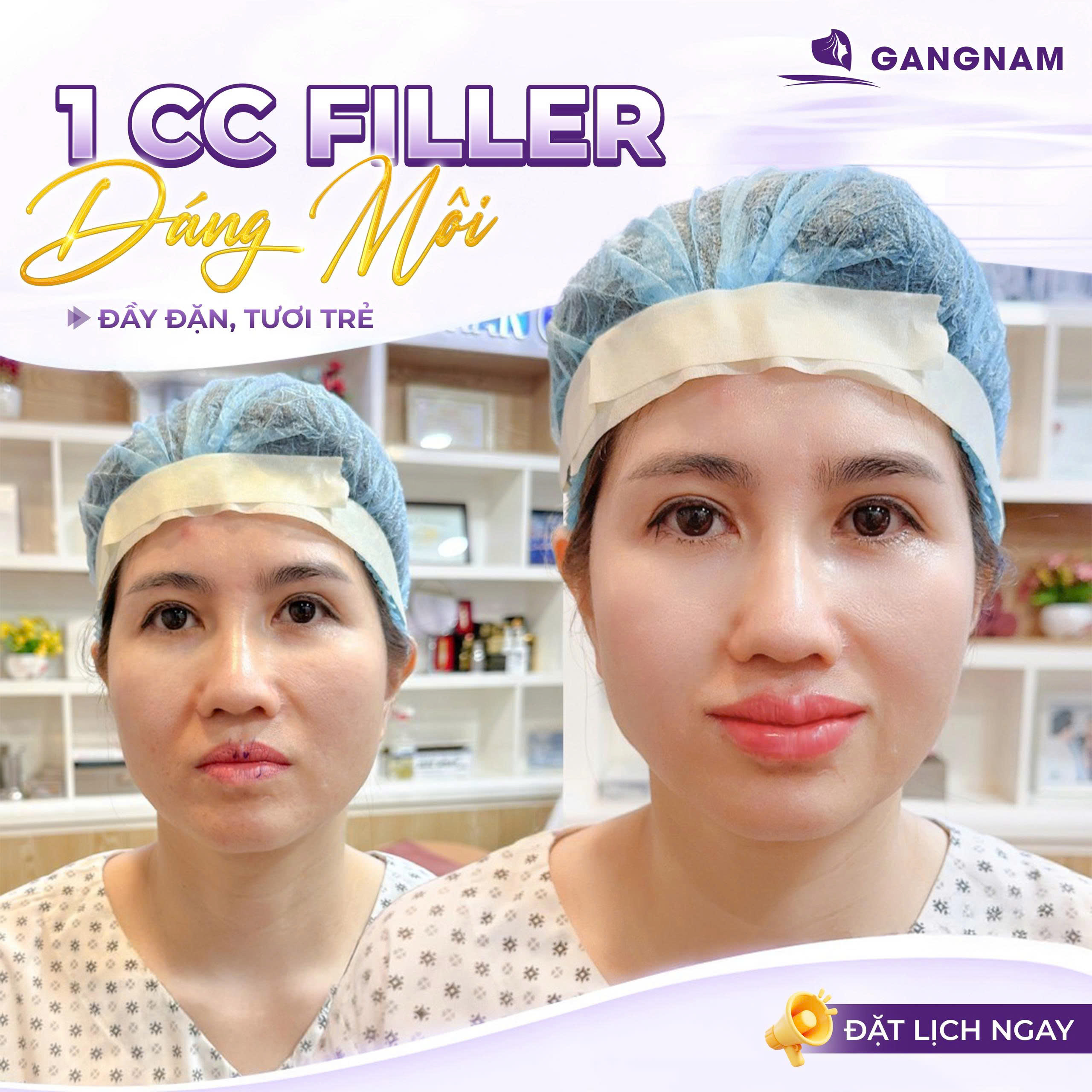 Môi Căng Mọng Nhờ Filler: Bí Quyết Sở Hữu Đôi Môi Quyến Rũ Tự Nhiên 5 Các dáng môi hot trend với môi căng mọng nhờ filler