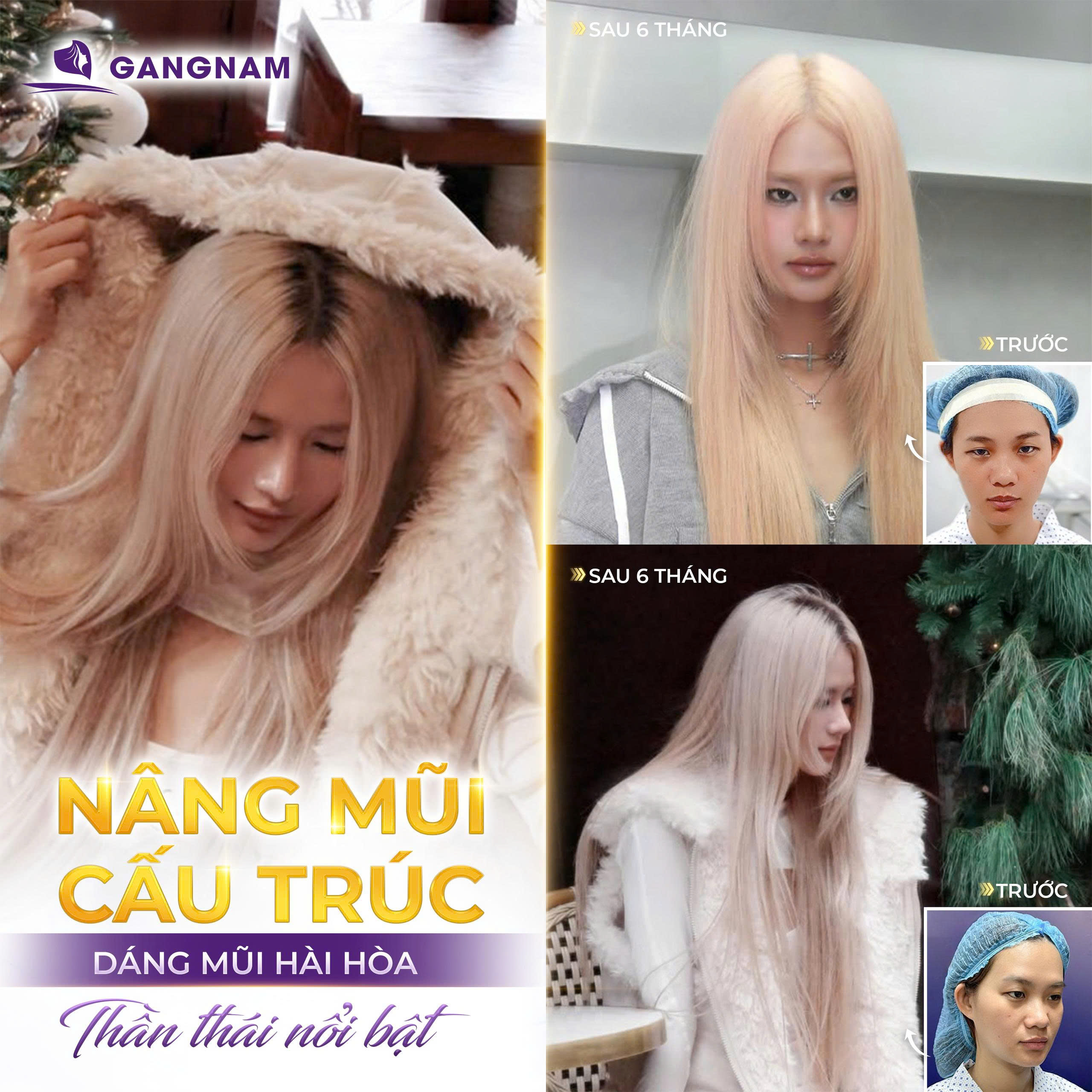 Nâng mũi công nghệ nội soi 4k – giải pháp thẩm mỹ mũi chính xác và an toàn 6 Thẩm mỹ Gangnam – Địa chỉ nâng mũi công nghệ nội soi 4K uy tín, chuẩn an toàn