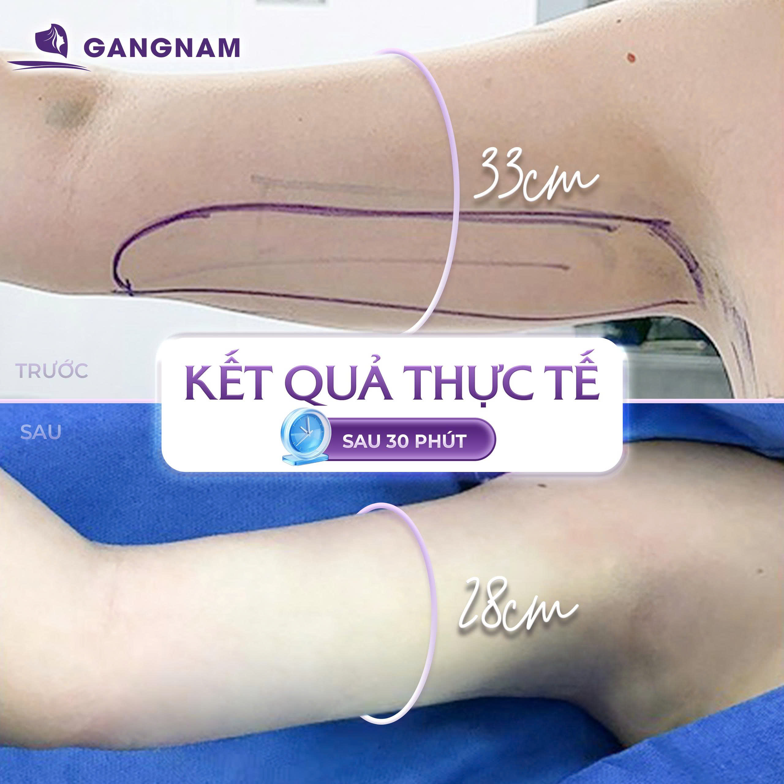 Hút Mỡ Tay Lipo: Giải Pháp Thon Gọn Cánh Tay Hiện Đại, An Toàn 4 Hút mỡ tay Lipo là gì và cơ chế hoạt động