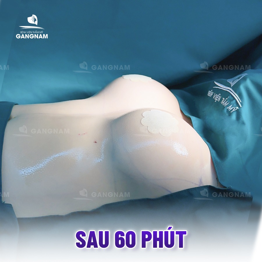 Nâng Ngực Đặt Túi Motiva: Giải Pháp Tạo Dáng Vòng Một Tự Nhiên, An Toàn 4 Nâng ngực đặt túi Motiva là gì?