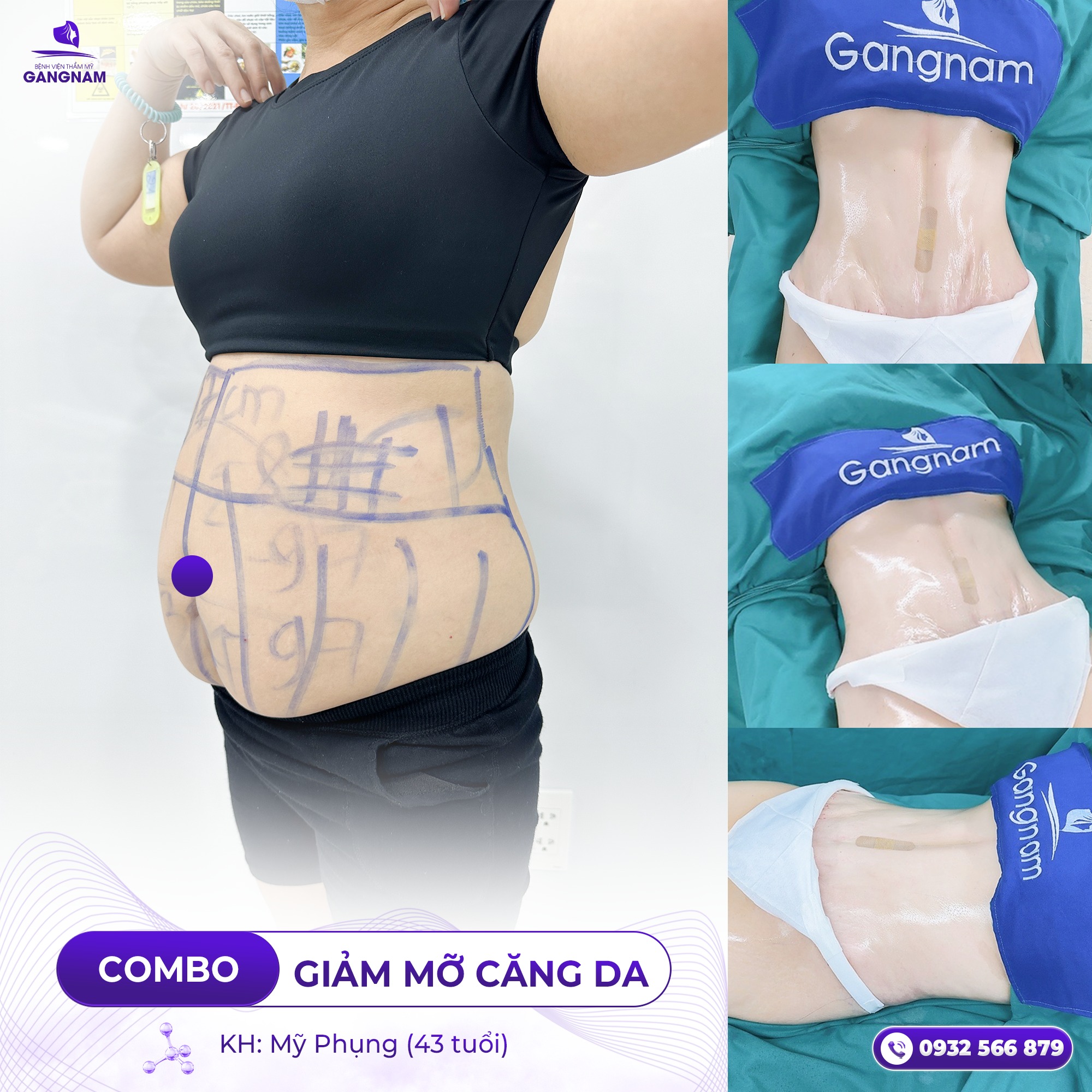 Hút Mỡ Vòng Eo Lipo Ultrasound – Giải Pháp Eo Thon Nhanh Chóng An Toàn 5 Những lưu ý quan trọng sau khi thực hiện hút mỡ vòng eo Lipo Ultrasound