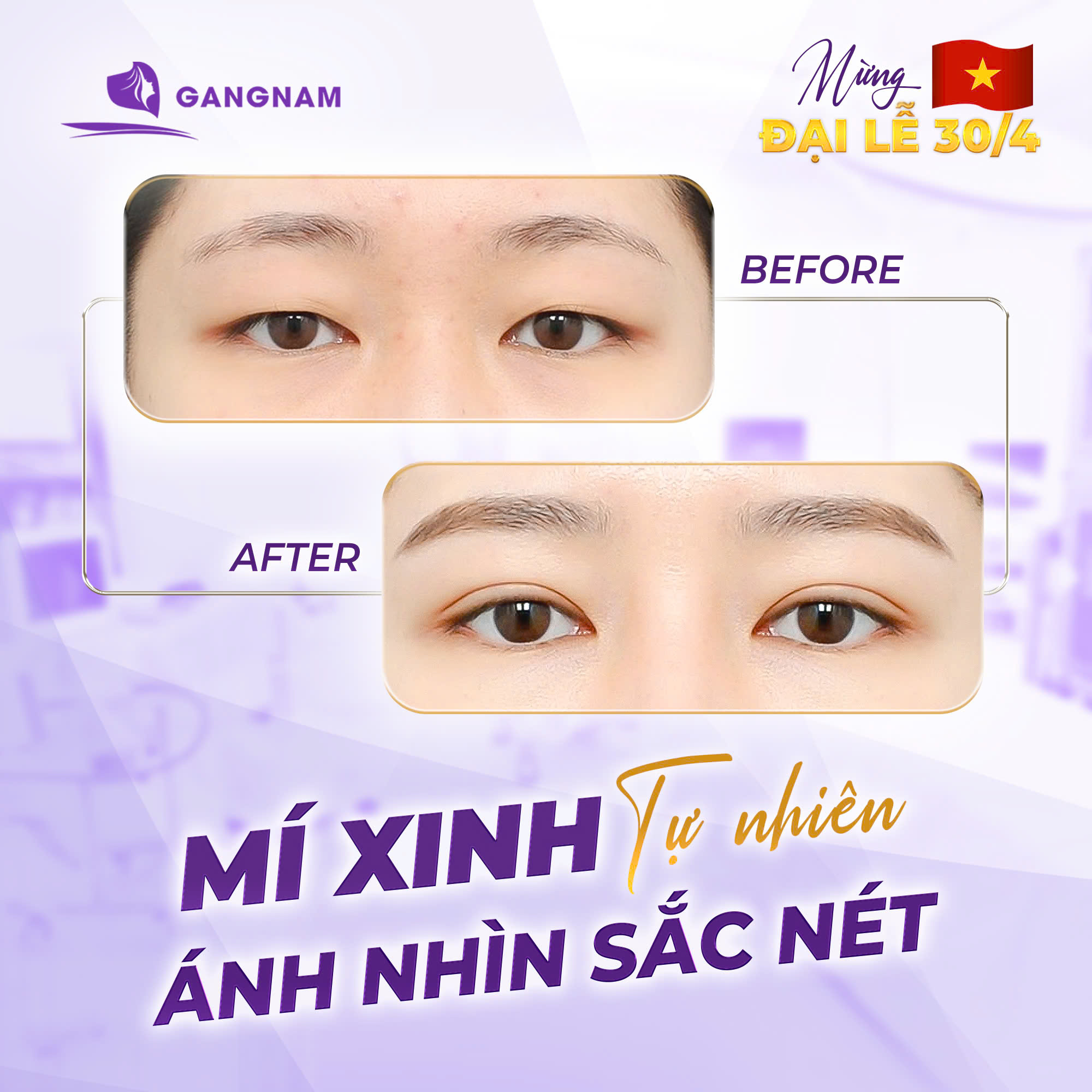 Cắt Mí Plasma An Toàn: Công Nghệ Hiện Đại Giúp Mắt Đẹp Nhanh 5 Quy trình thực hiện cắt mí plasma an toàn chuẩn y khoa