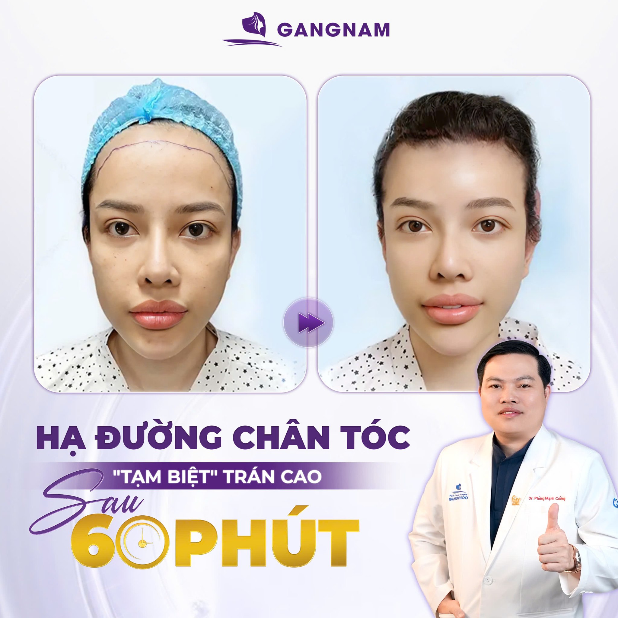 Hạ Đường Chân Tóc Nội Soi: Giải Pháp Thu Gọn Trán Cao An Toàn, Tự Nhiên 5 Quy trình thực hiện và thời gian hồi phục sau hạ đường chân tóc nội soi