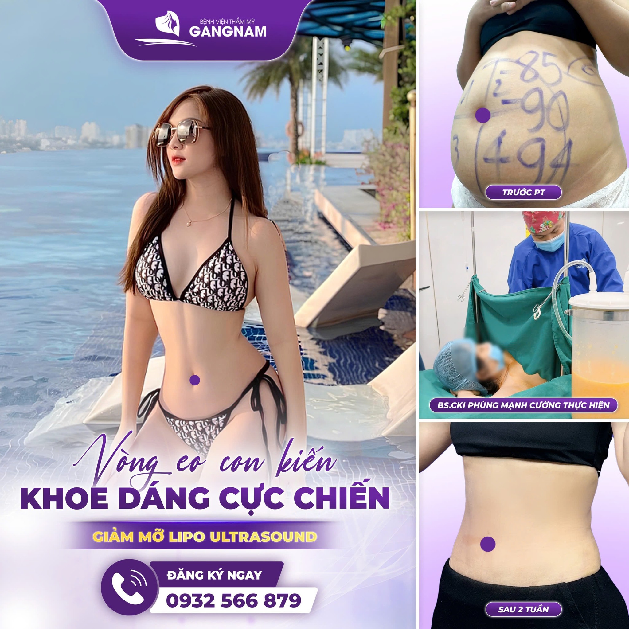 Hút mỡ hông nội soi: Giải pháp tạo đường cong S-line an toàn, hiệu quả 6 Hút mỡ hông nội soi an toàn, chuẩn y khoa tại Thẩm mỹ Gangnam