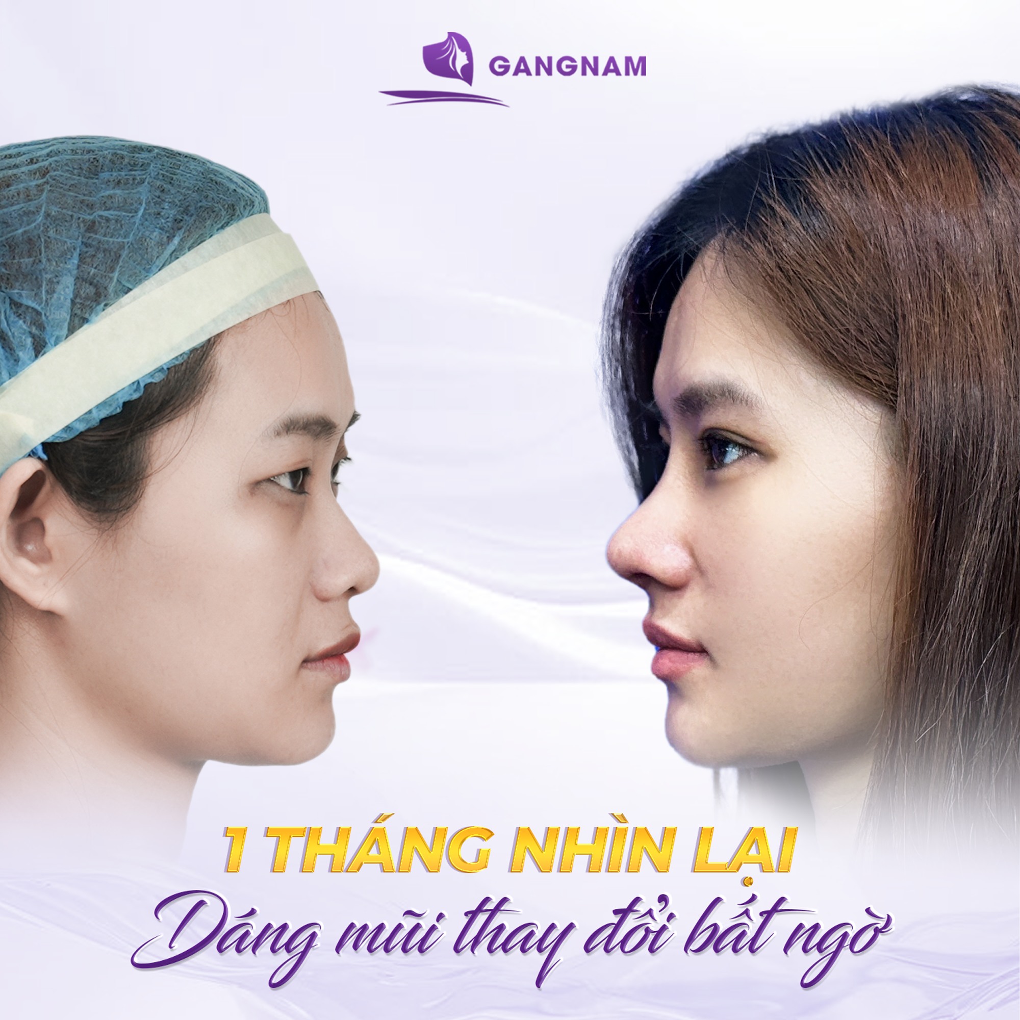 Nâng mũi 3D cân đối tỷ lệ vàng – Giải pháp cá nhân hóa dáng mũi hài hòa với khuôn mặt 5 Nâng mũi 3D cân đối tỷ lệ vàng – Giải pháp cá nhân hóa dáng mũi hài hòa với khuôn mặt 2