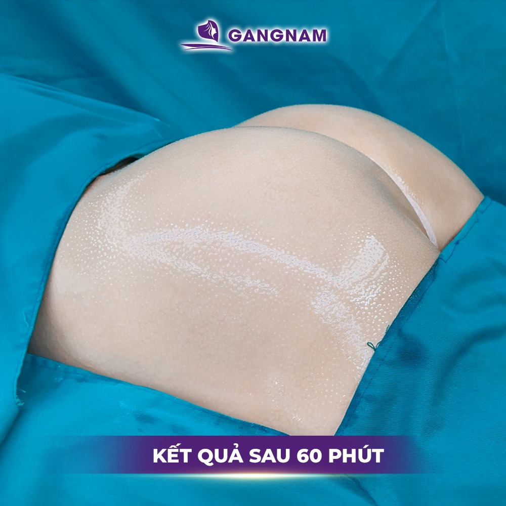 Nâng Mông Nội Soi Chuyên Sâu: Giải Pháp Tạo Dáng Vòng 3 Tự Nhiên 4 Nâng mông nội soi chuyên sâu là gì