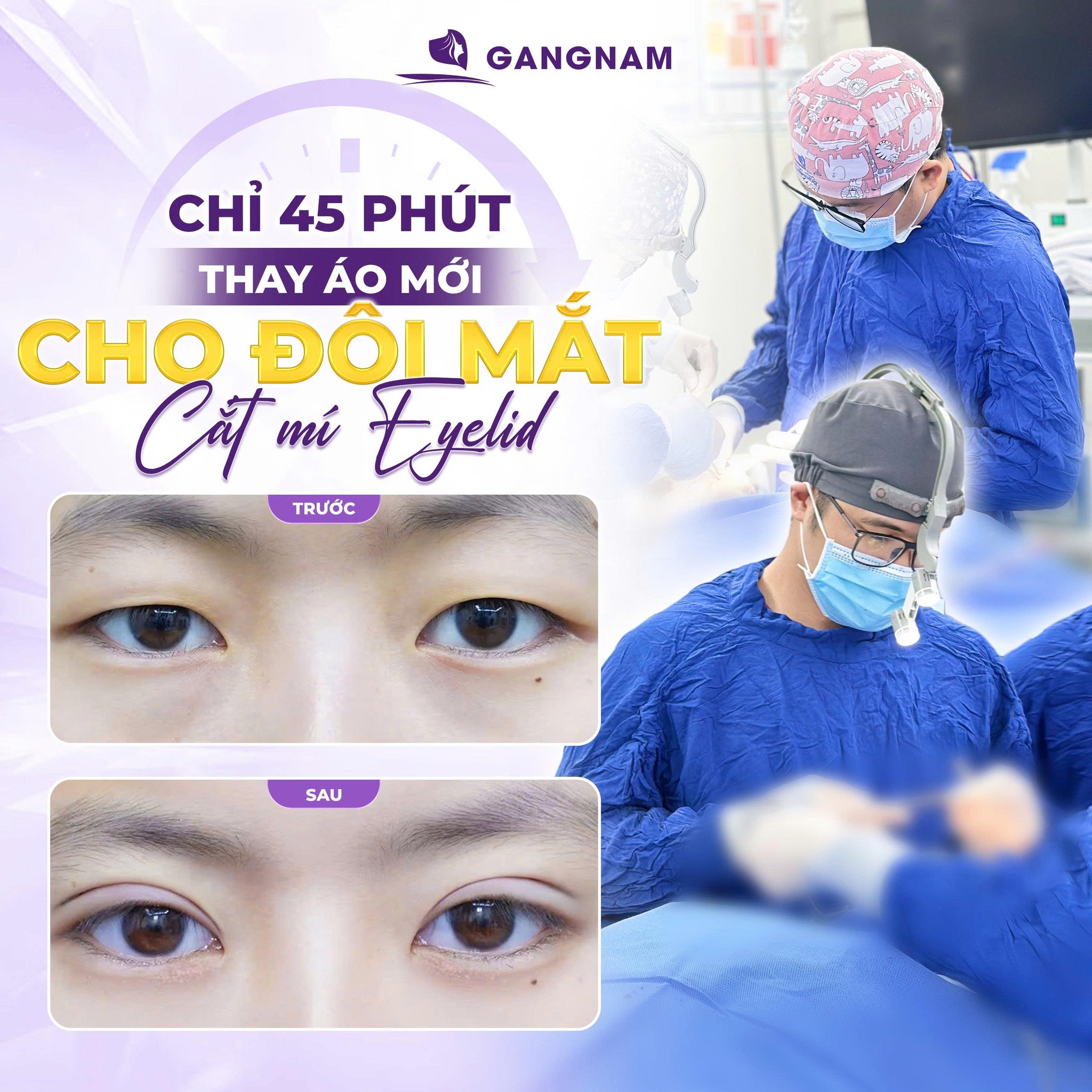 Cắt mí style Hàn Quốc: Bí quyết sở hữu đôi mắt to tròn, tự nhiên 5 Quy trình thực hiện cắt mí style Hàn Quốc tiêu chuẩn y khoa