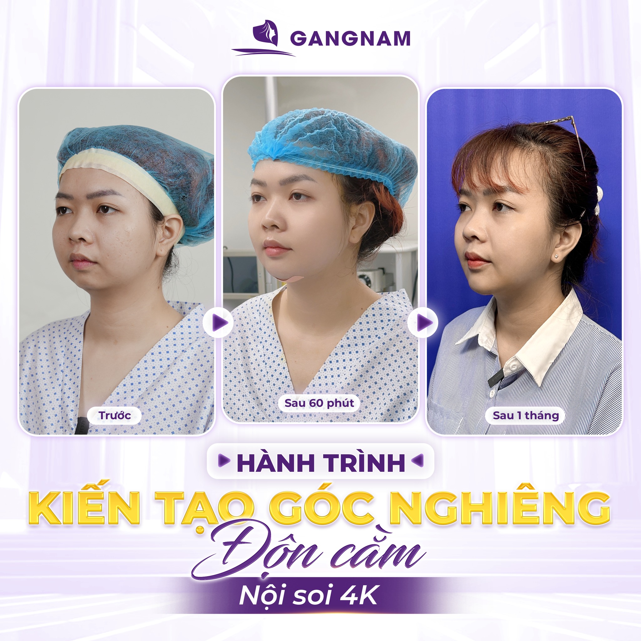 Phẫu Thuật Nâng Cằm V Line: Quy Trình, Lợi Ích & Lưu Ý Quan Trọng 5 Những ai nên thực hiện phẫu thuật nâng cằm V line