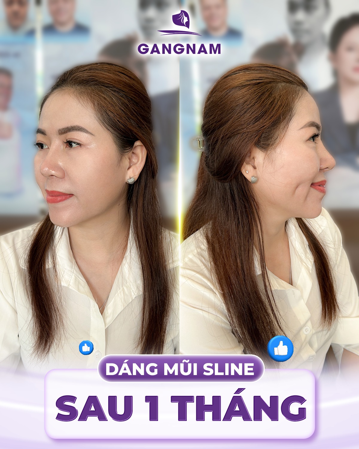 Nâng Mũi Dáng S-Line: Bí Quyết Sở Hữu Dáng Mũi Tự Nhiên, Hài Hòa Chuẩn Á Đông 5 Quy trình thực hiện nâng mũi dáng S-line chuẩn y khoa